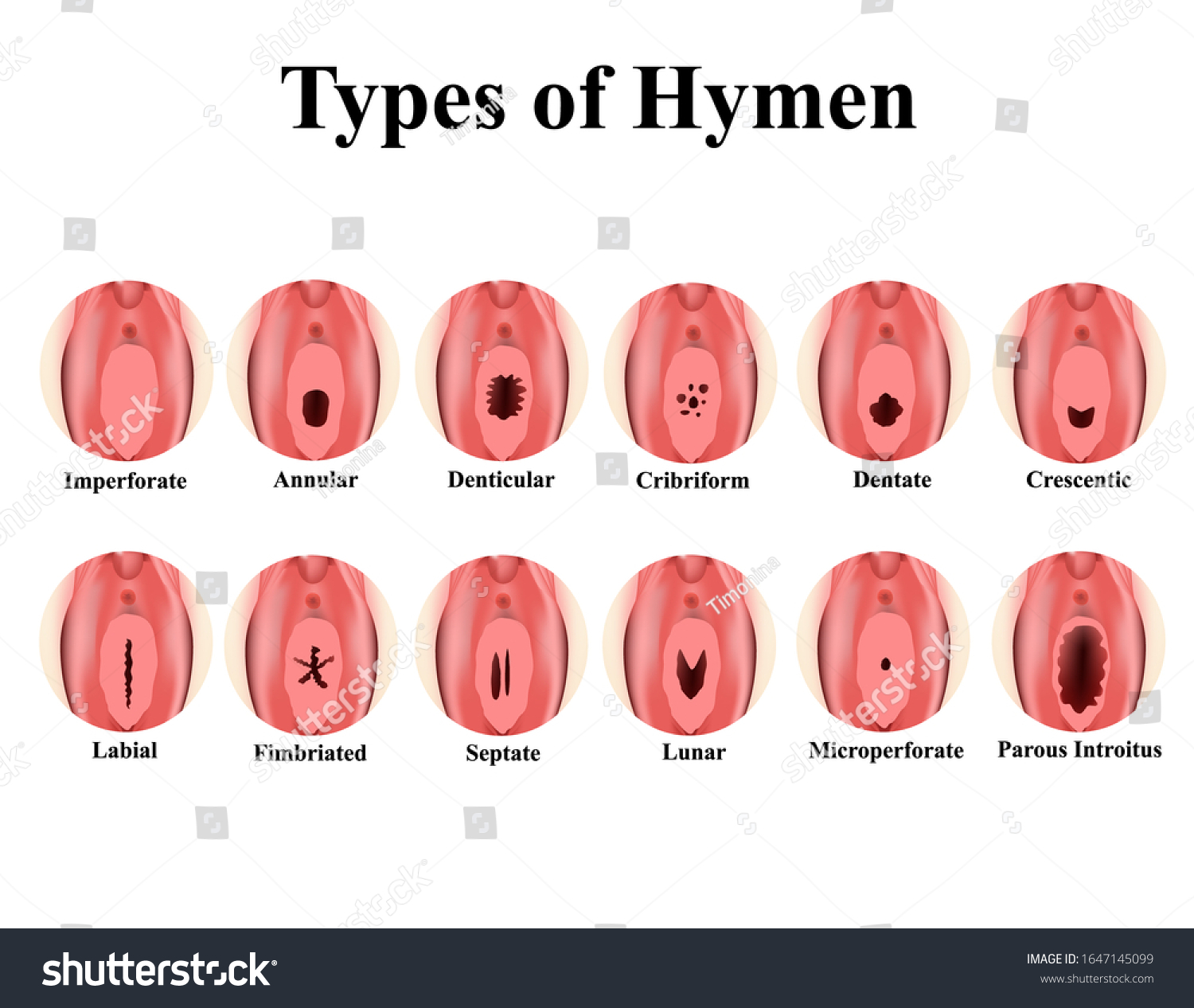 Types Hymen Imperforate Annular Denticular Cribriform Ilustra Es Stock Shutterstock