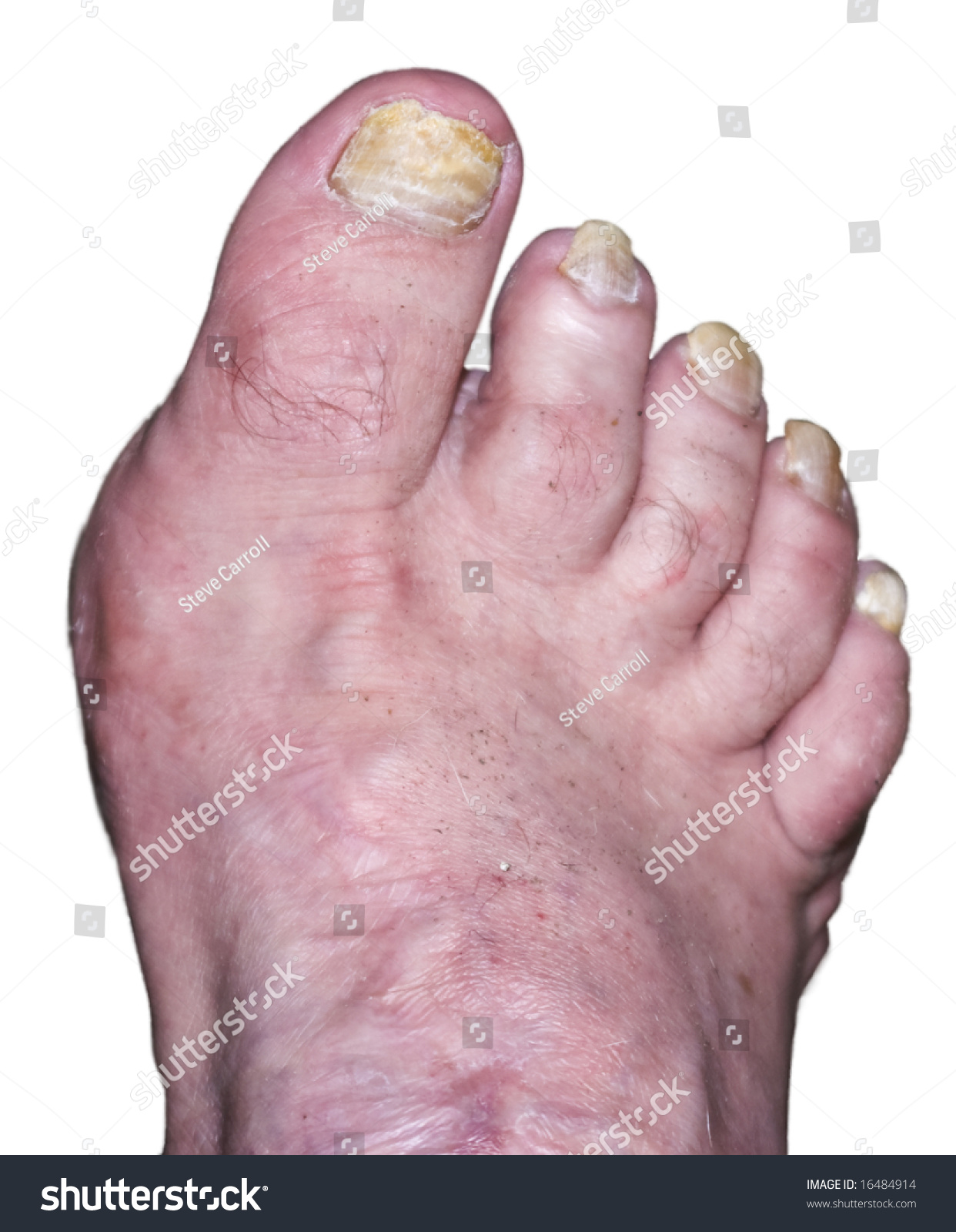 Ugly, Deformed Foot With Toenail Fungus, Isolated On A White Background