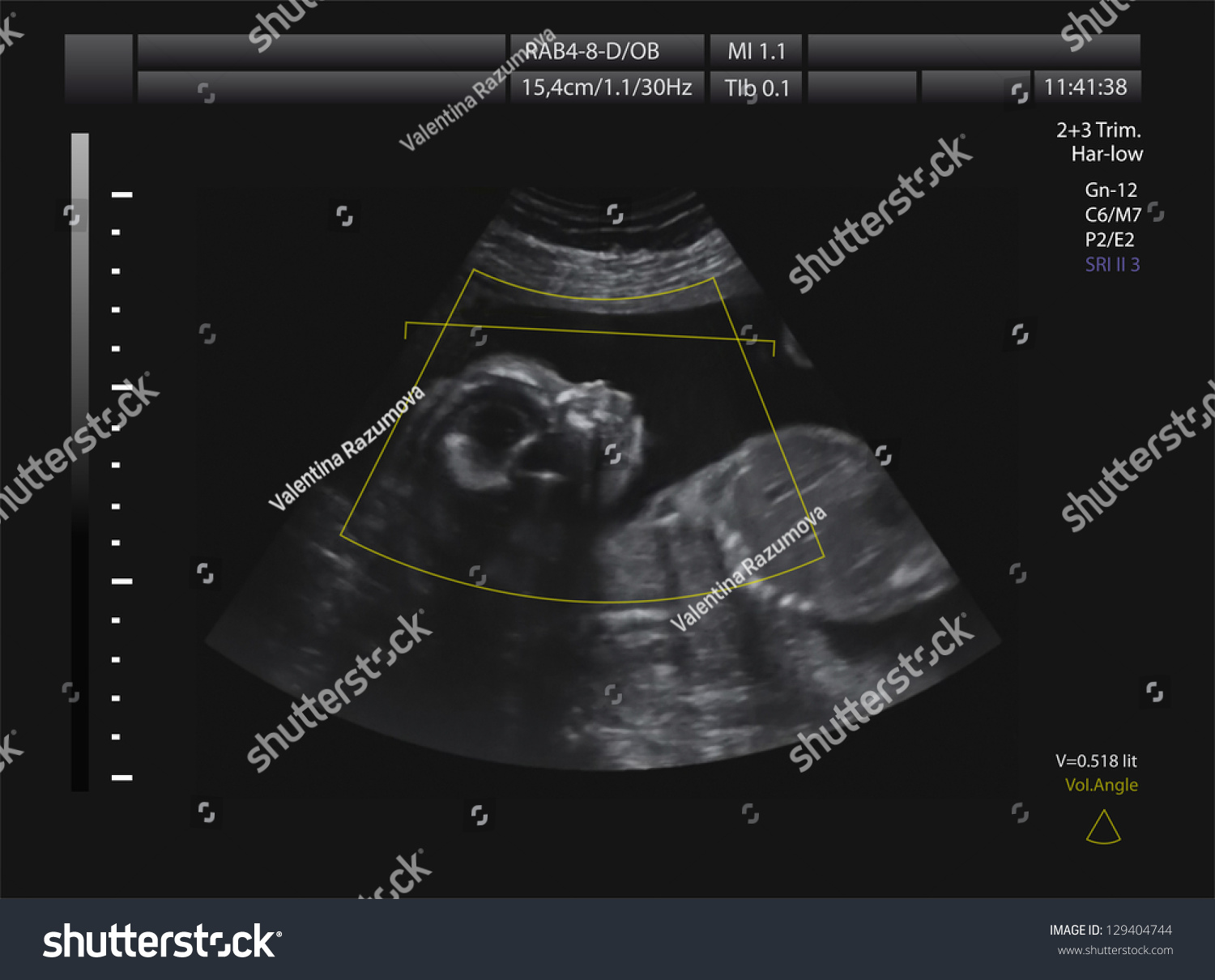 Ultrasound Of Baby In Mother S Womb Stock Photo Shutterstock