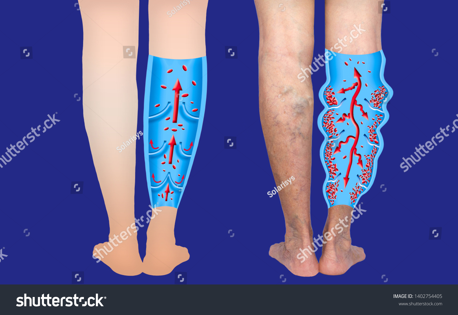 Varicose Eczema Images Stock Photos Vectors Shutterstock