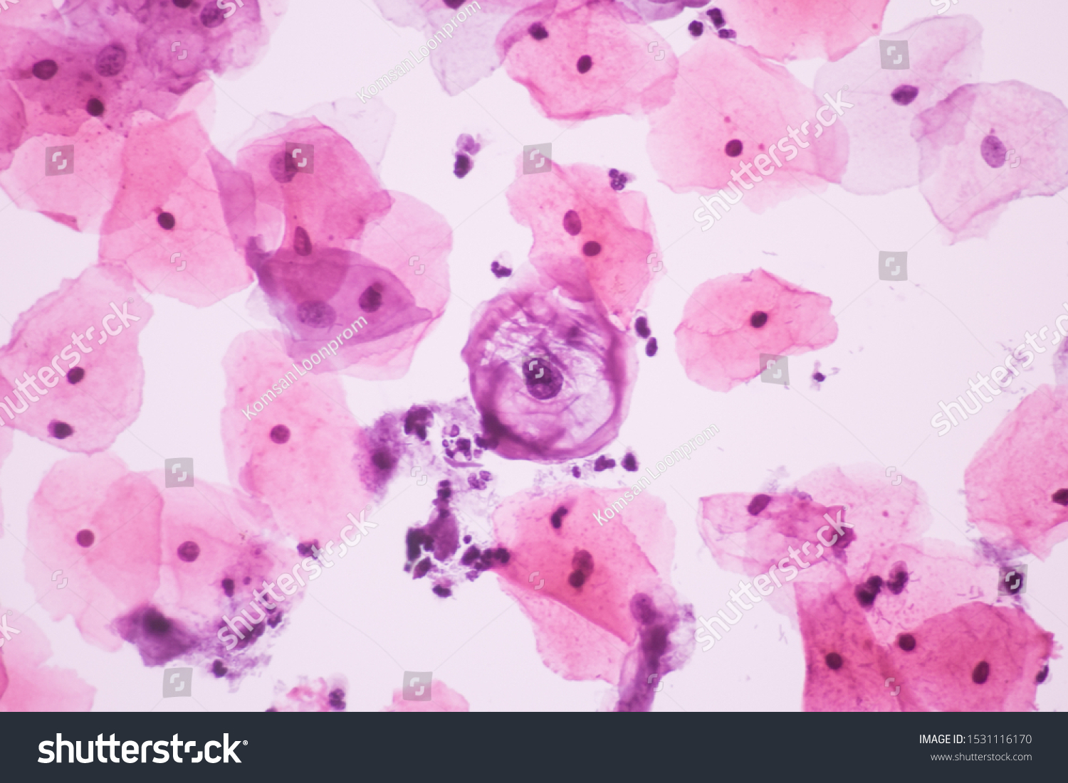 View Microscopic Abnormal Human Cervix Cellskoilocyte Stock Photo