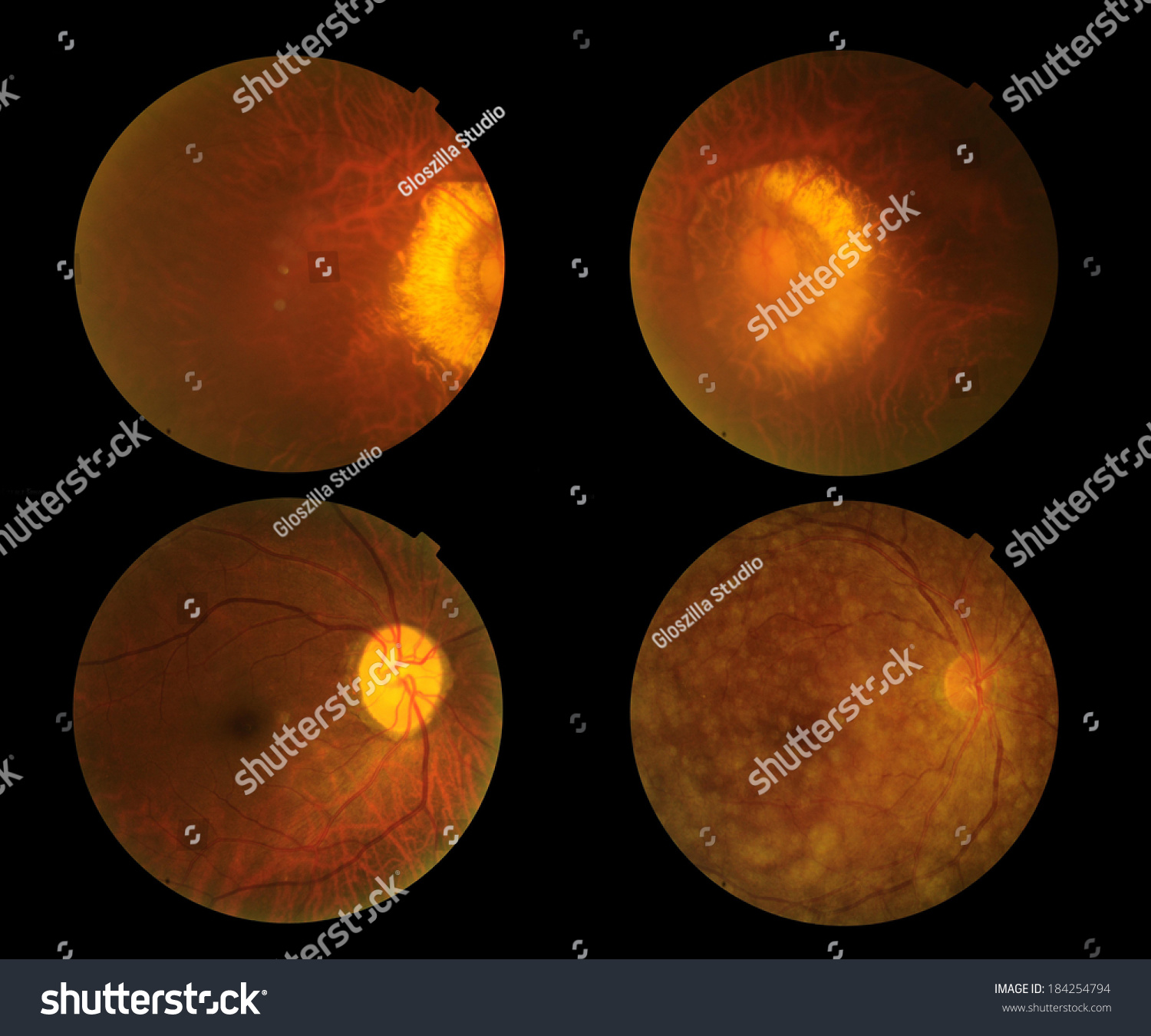 View Set Inside Human Eye Disorders Showing Retina Optic Nerve And