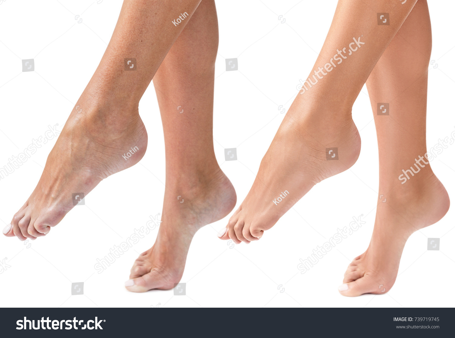 Womans Dry Feet Before After Treatment Stock Photo Shutterstock