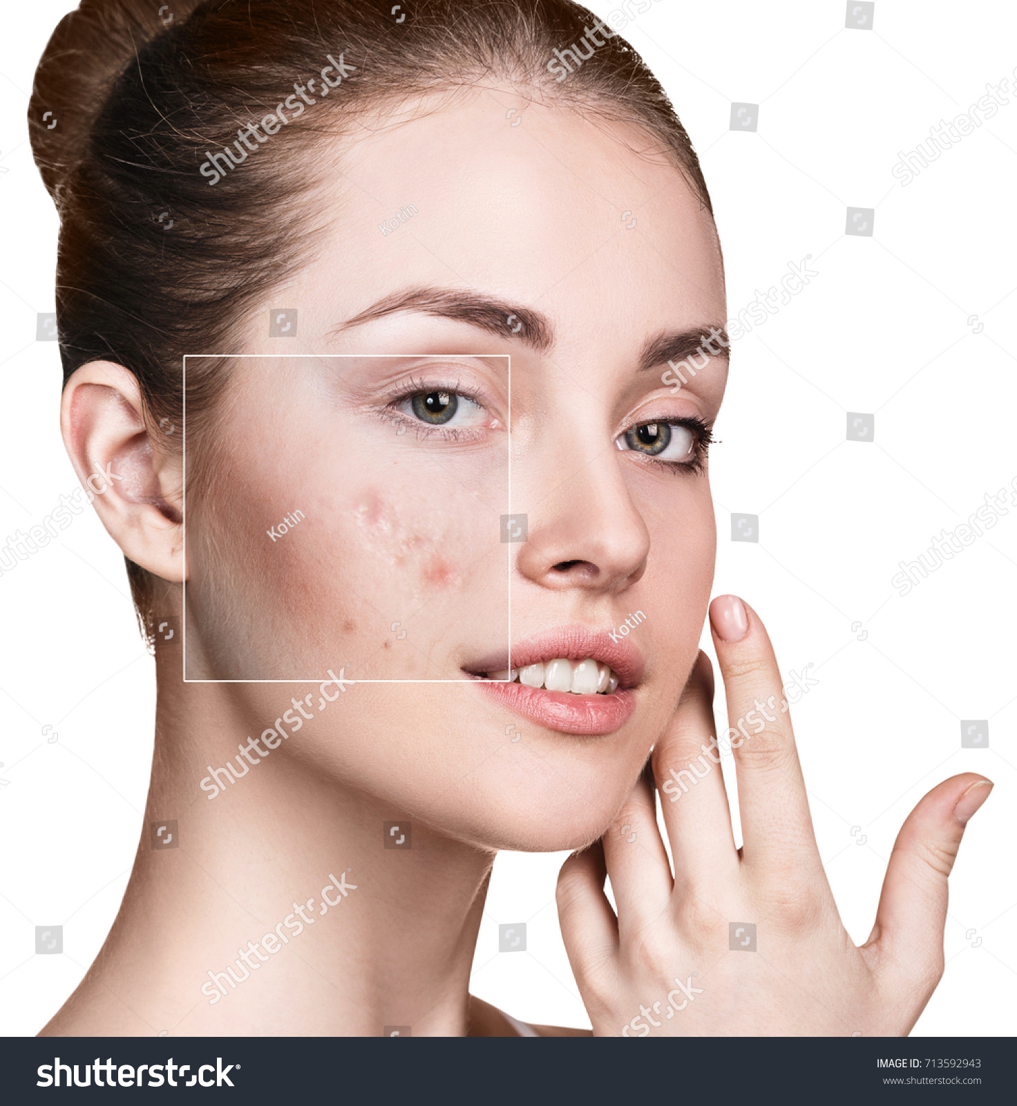 Womans Face Before After Treatment Stock Photo Edit Now