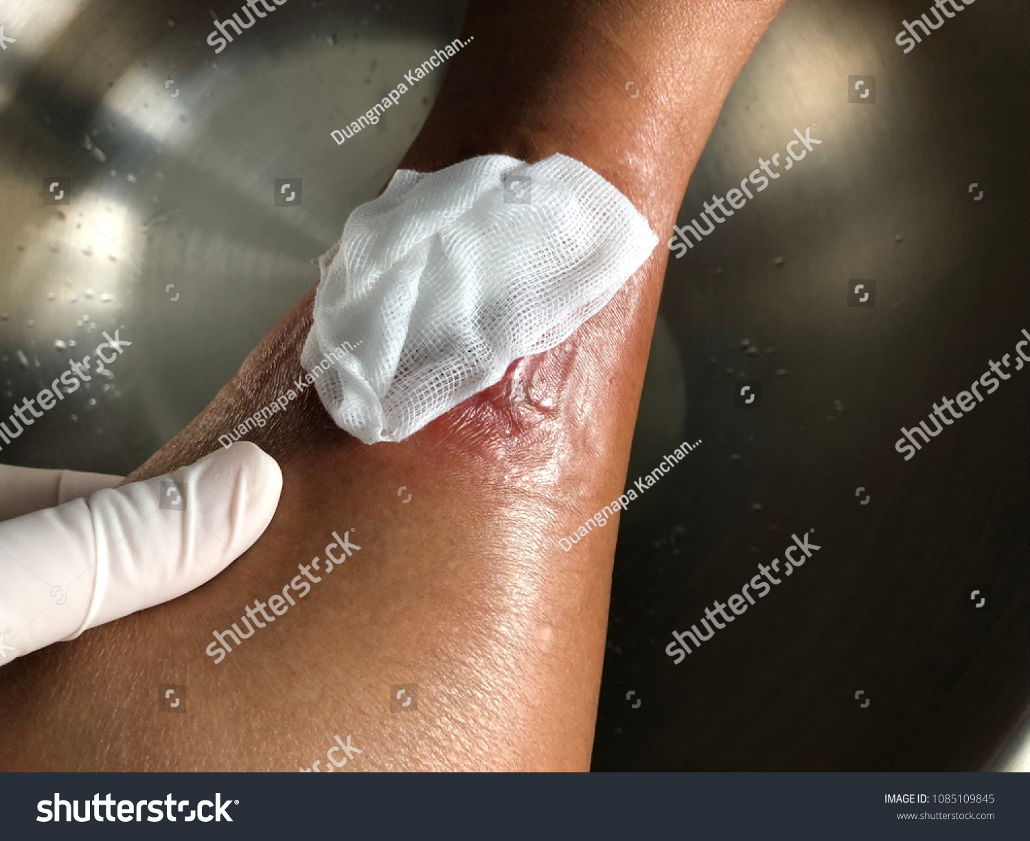 Wounddressing Wound Infected Wound Diabetic Foot Stock Photo 1085109845