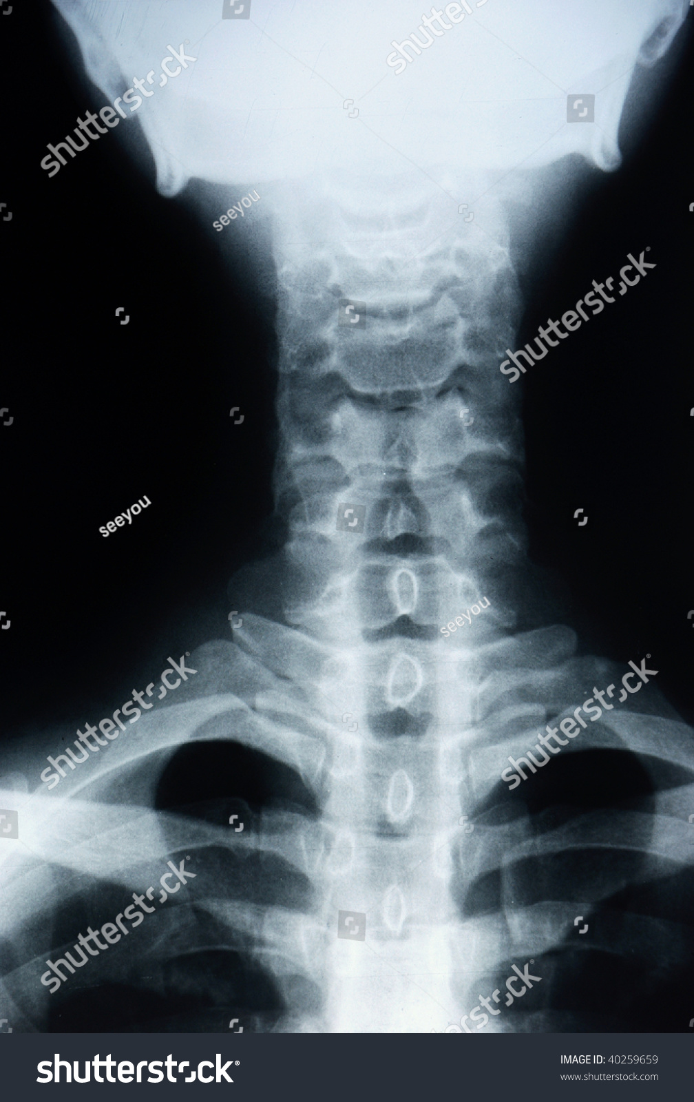X Ay Of The Cervical Spine En Lateral View X Ay Of The Cervical Spine En Lateral View Stock Photo