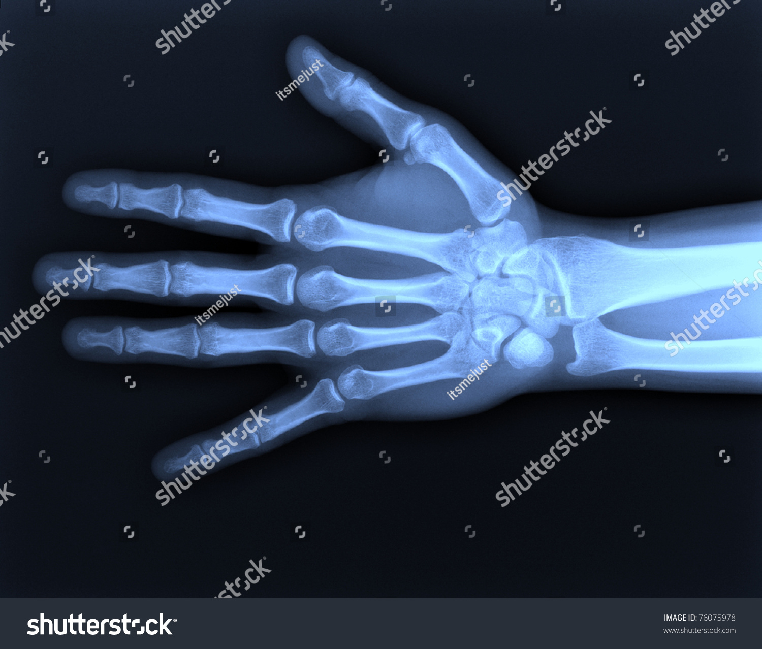hand x ray clipart - photo #37
