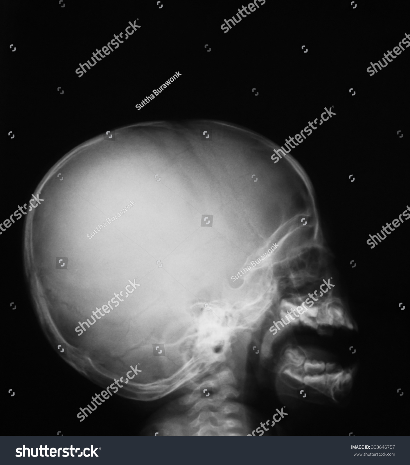 normal skull x ray lateral view child