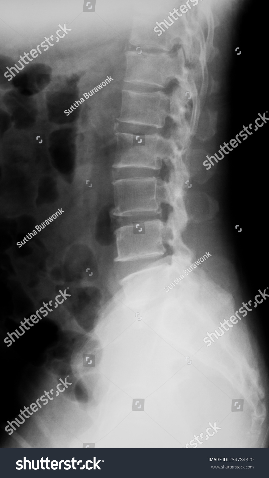 X Ray Image Of Lumbar Spine Lateral View Stock Photo