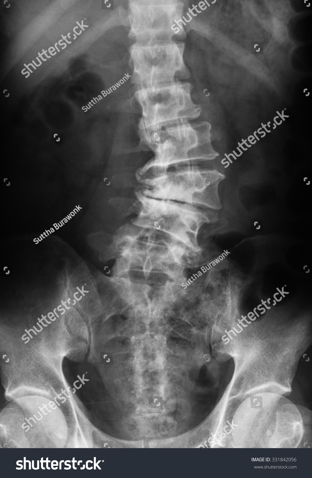 Xray Image Lumbosacral Spine Showing Osteoarthritis Stock Photo 