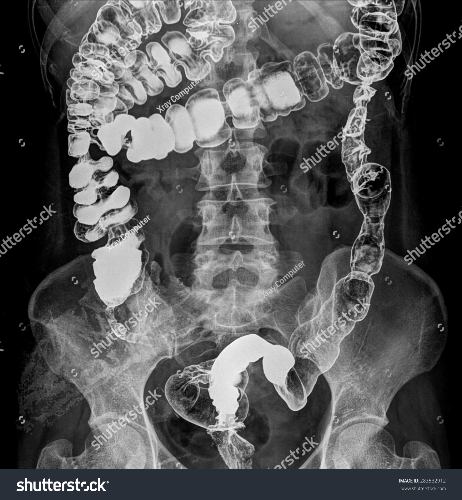 Xray Image Plain Abdomen Colon Stock Photo Shutterstock