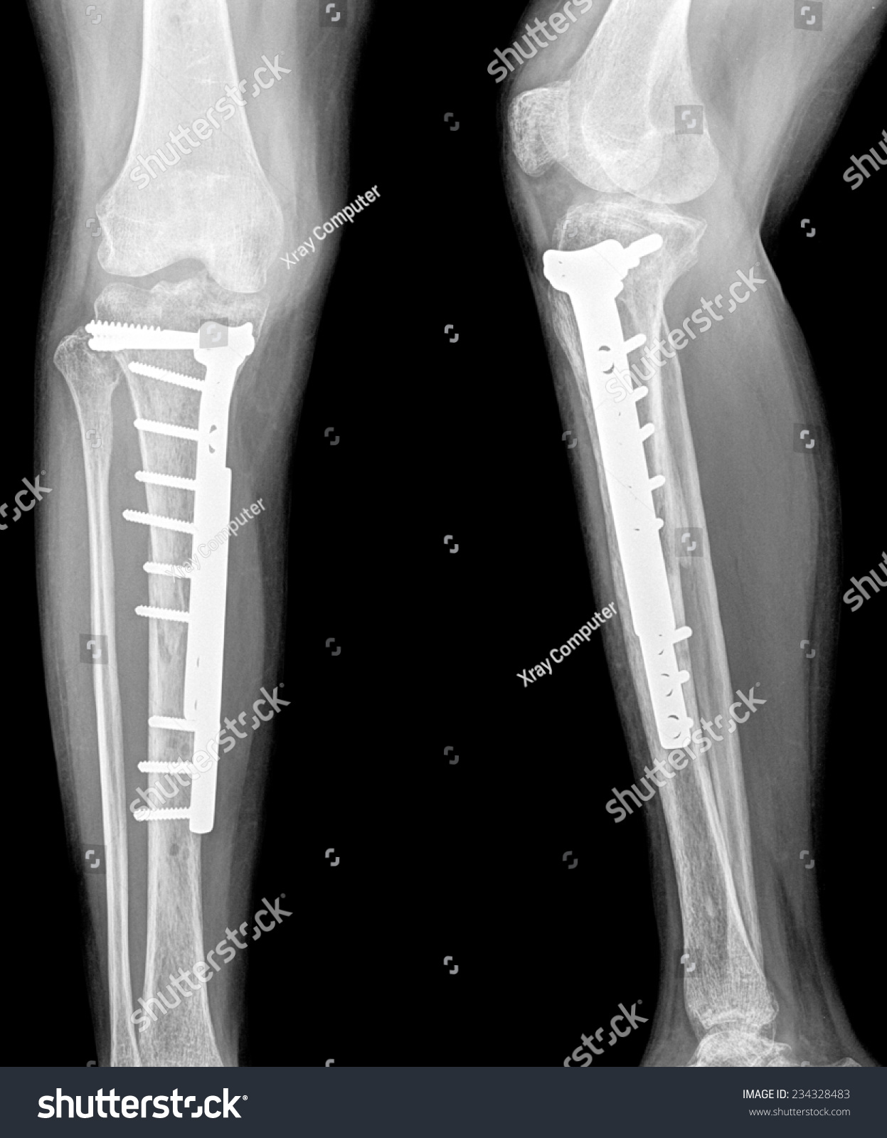 XRay Of A Cat'S Broken Leg After Surgery Stock Photo 234328483