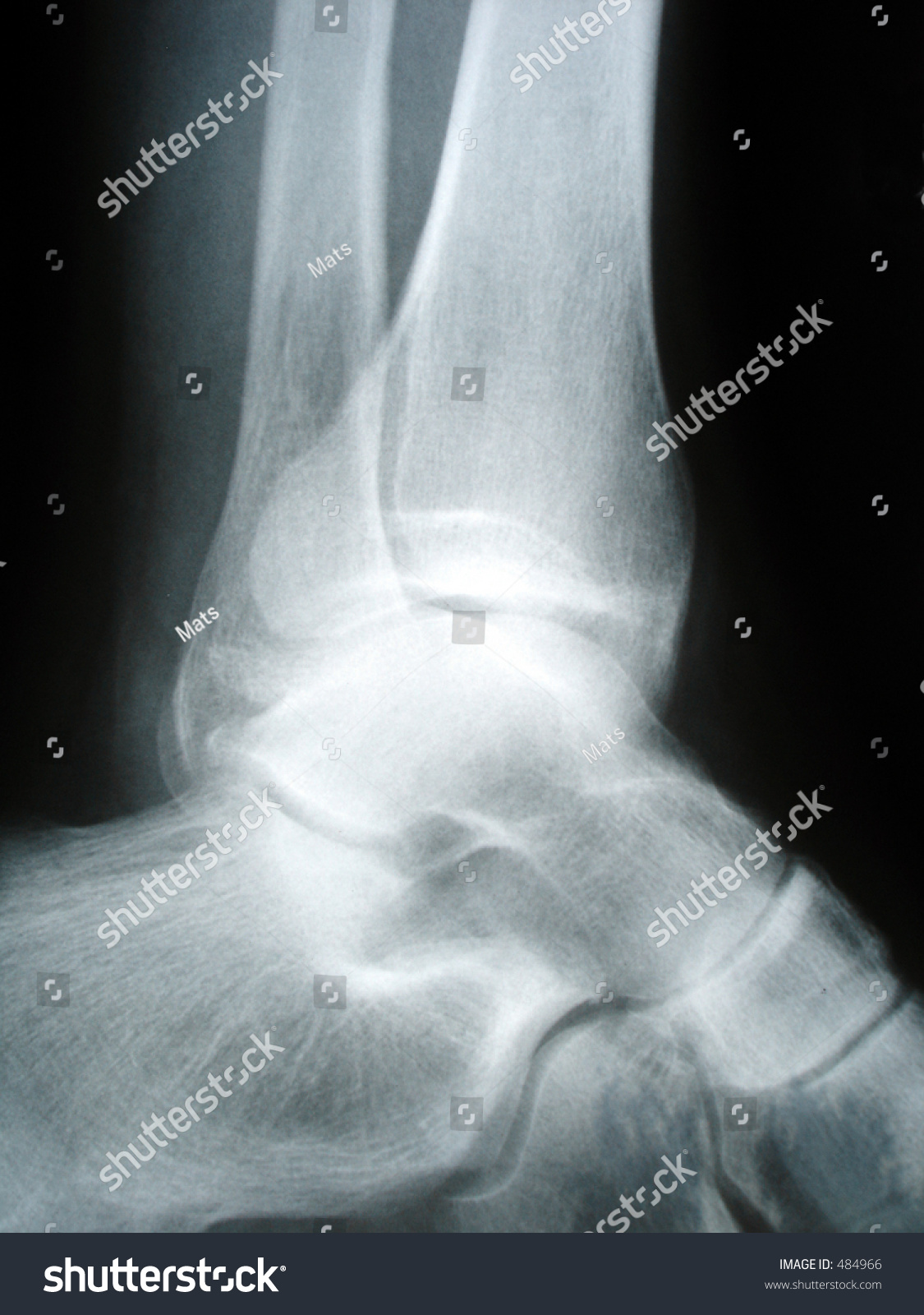 heel axial view x ray