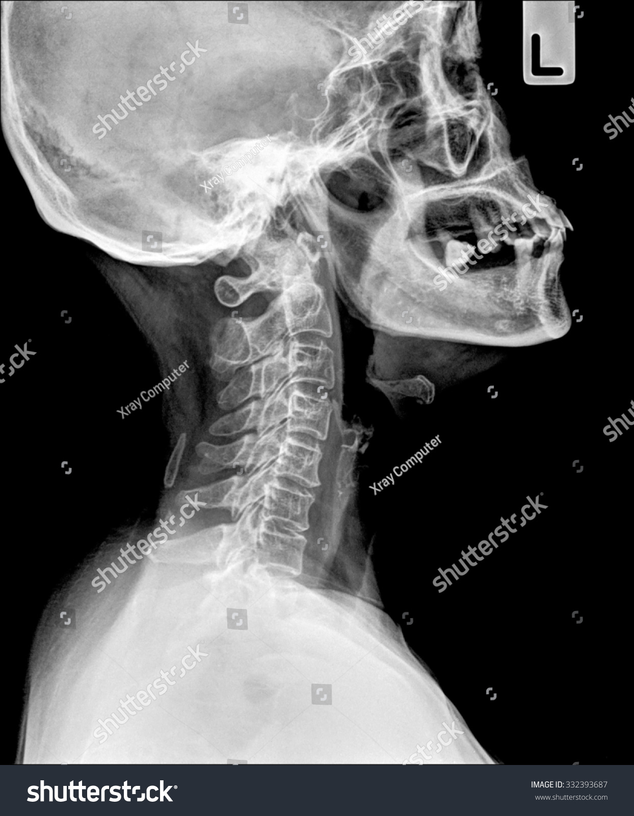 normal xray of neck side view