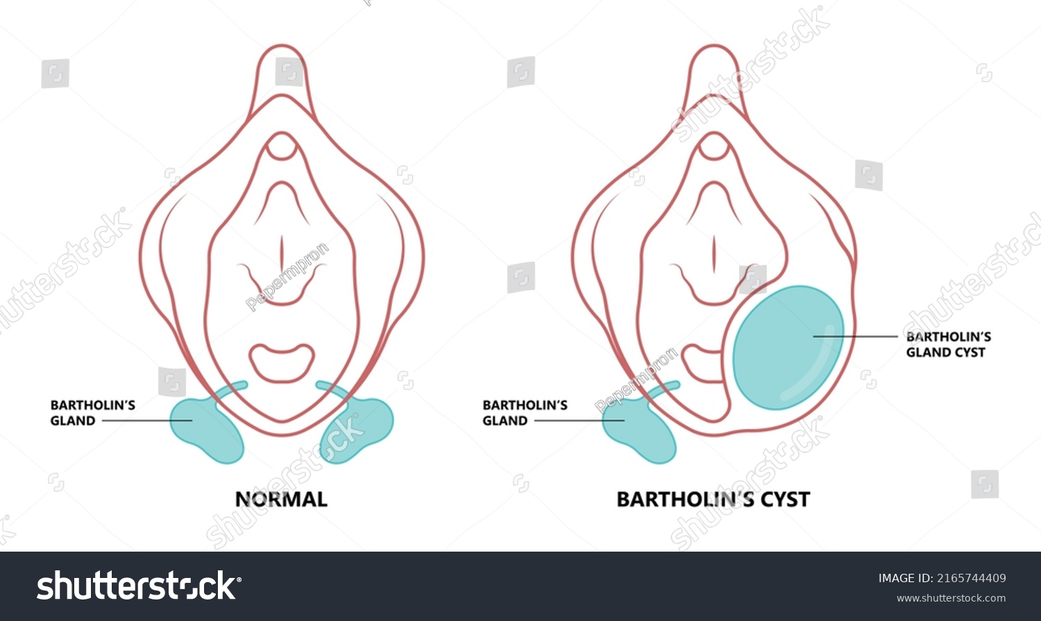 Bartholin Gland Images Stock Photos Vectors Shutterstock