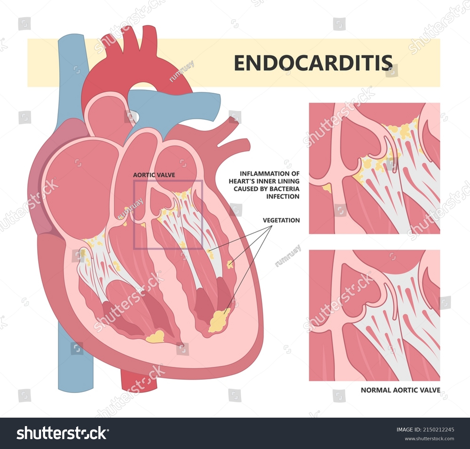 Estenosis de la enfermedad valvular aórtica vector de stock libre de