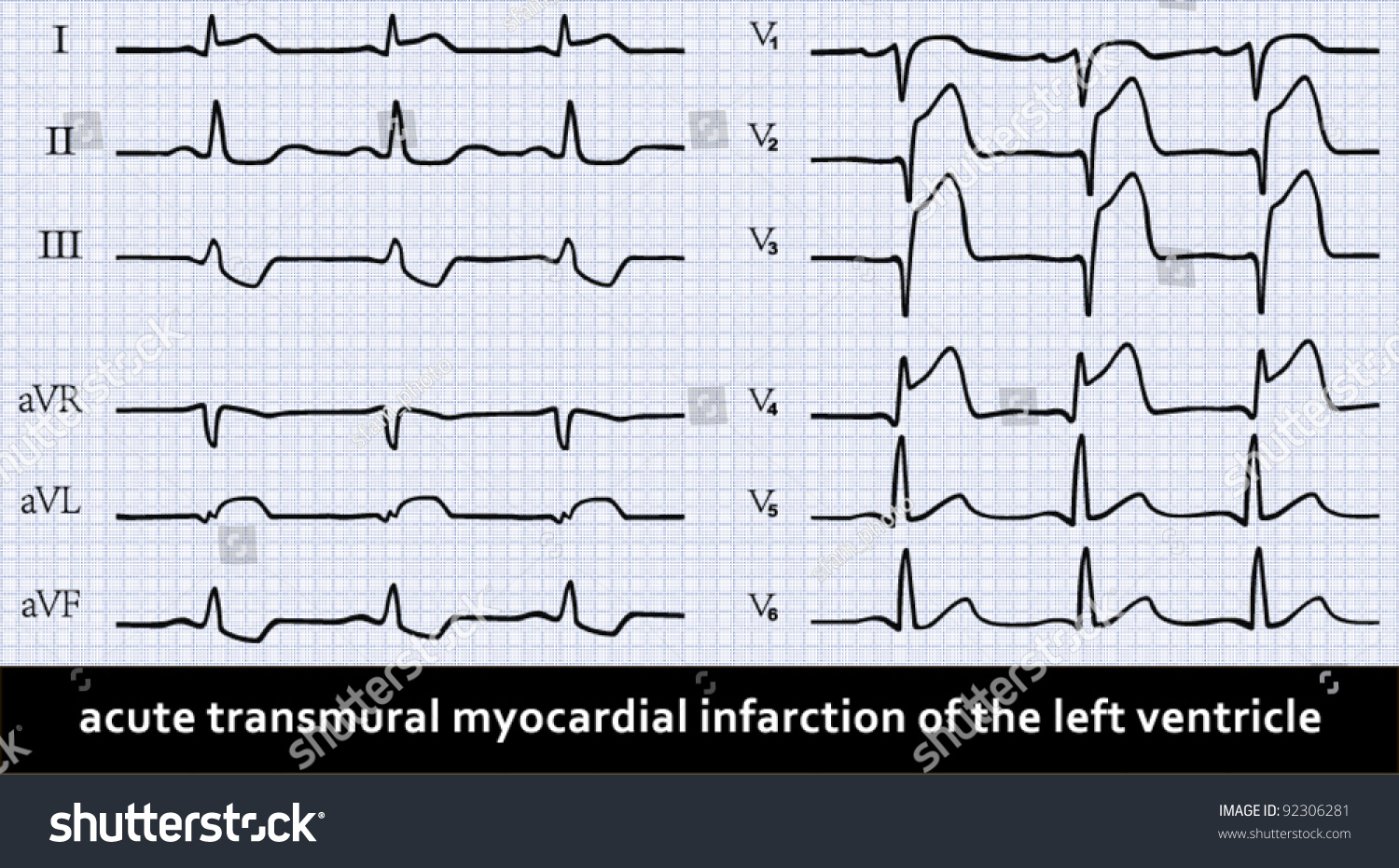 Acute Myocardial Infarction With Q-wave On Ecg. Detailed Vector 