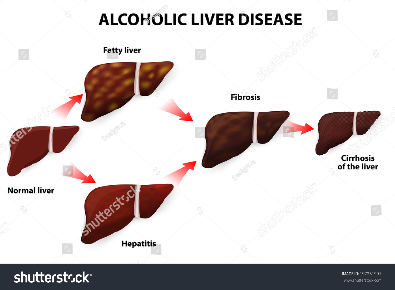 Cirrhosis of the liver chinese medicine 4am