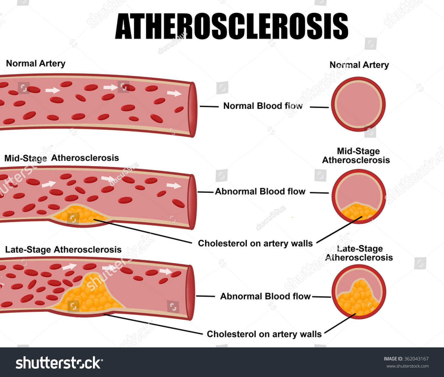 Atherosclerosis. Detailed Illustration Of Atherosclerosis Stages ...