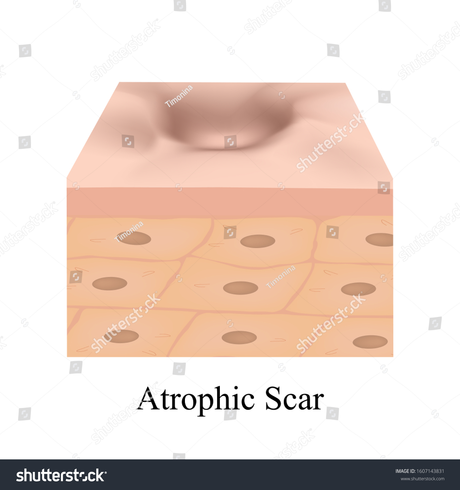 Atrophic Scars Acne Scar Anatomical Structure Stock Vector Royalty