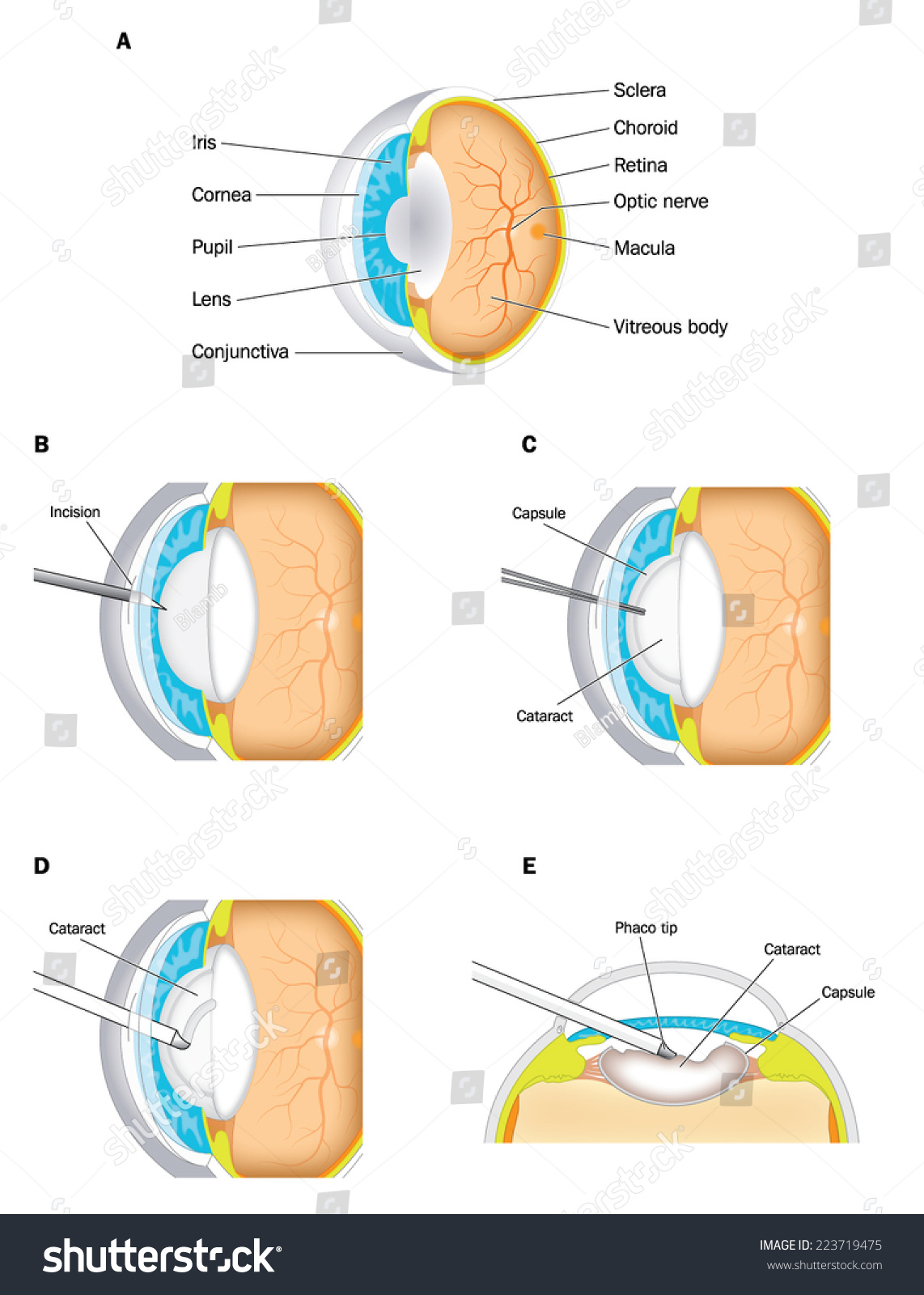 Procedure For Cataract Operation