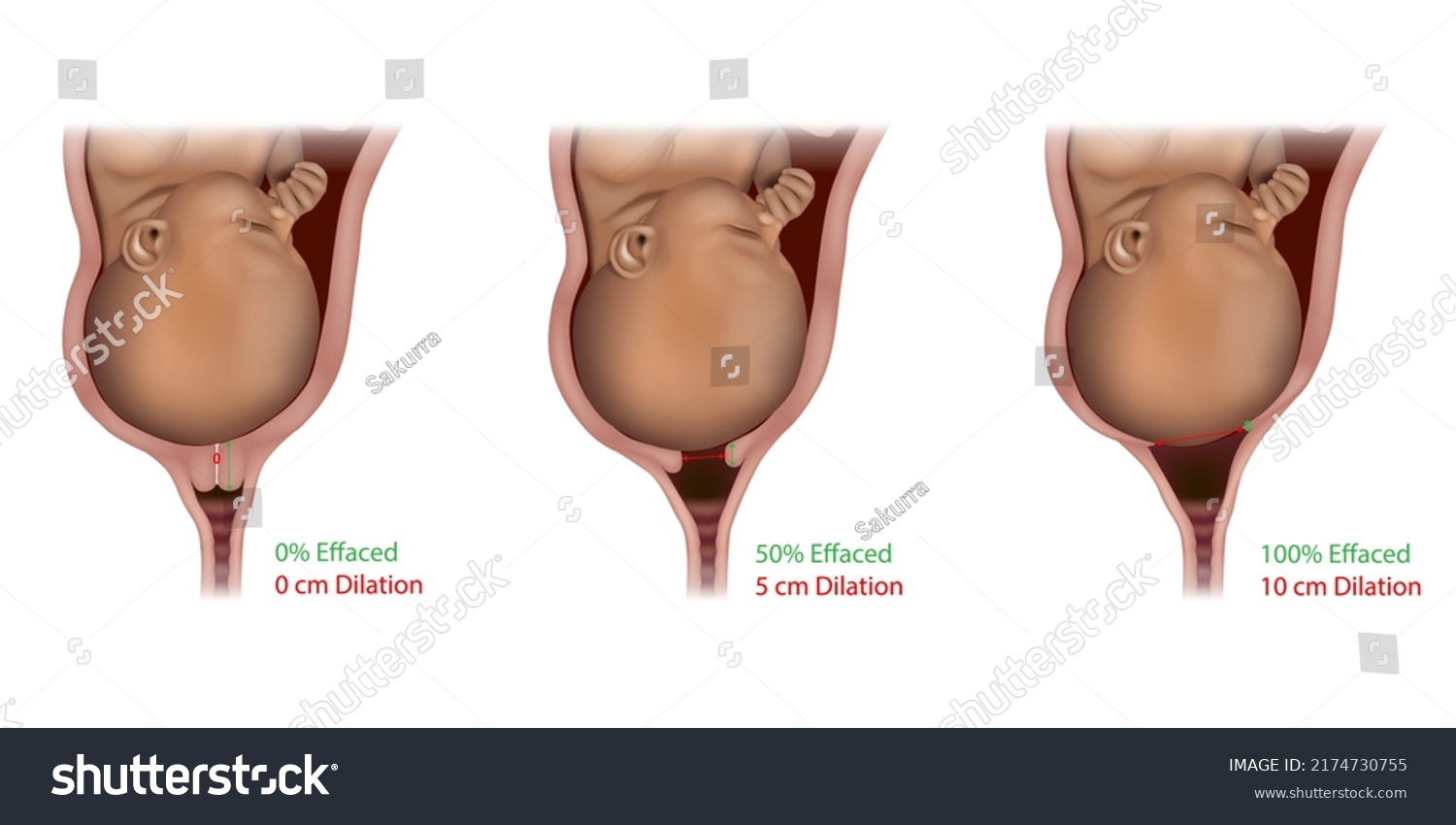 Cervical Effacement Dilation During Delivery Cervix Stock Vector