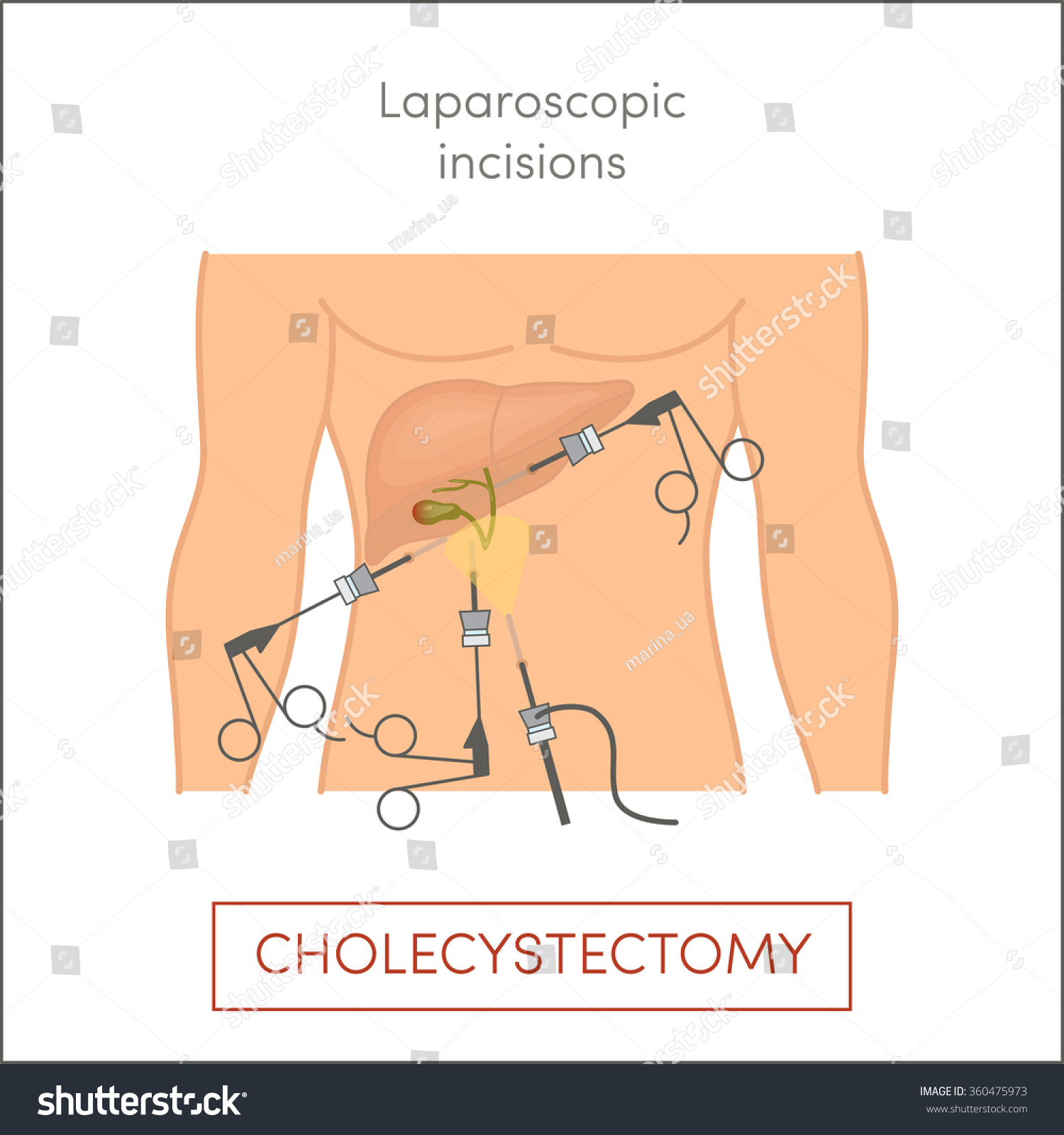 Cholecystectomy Surgical Removal Gallbladder Laparoscopic Incisions