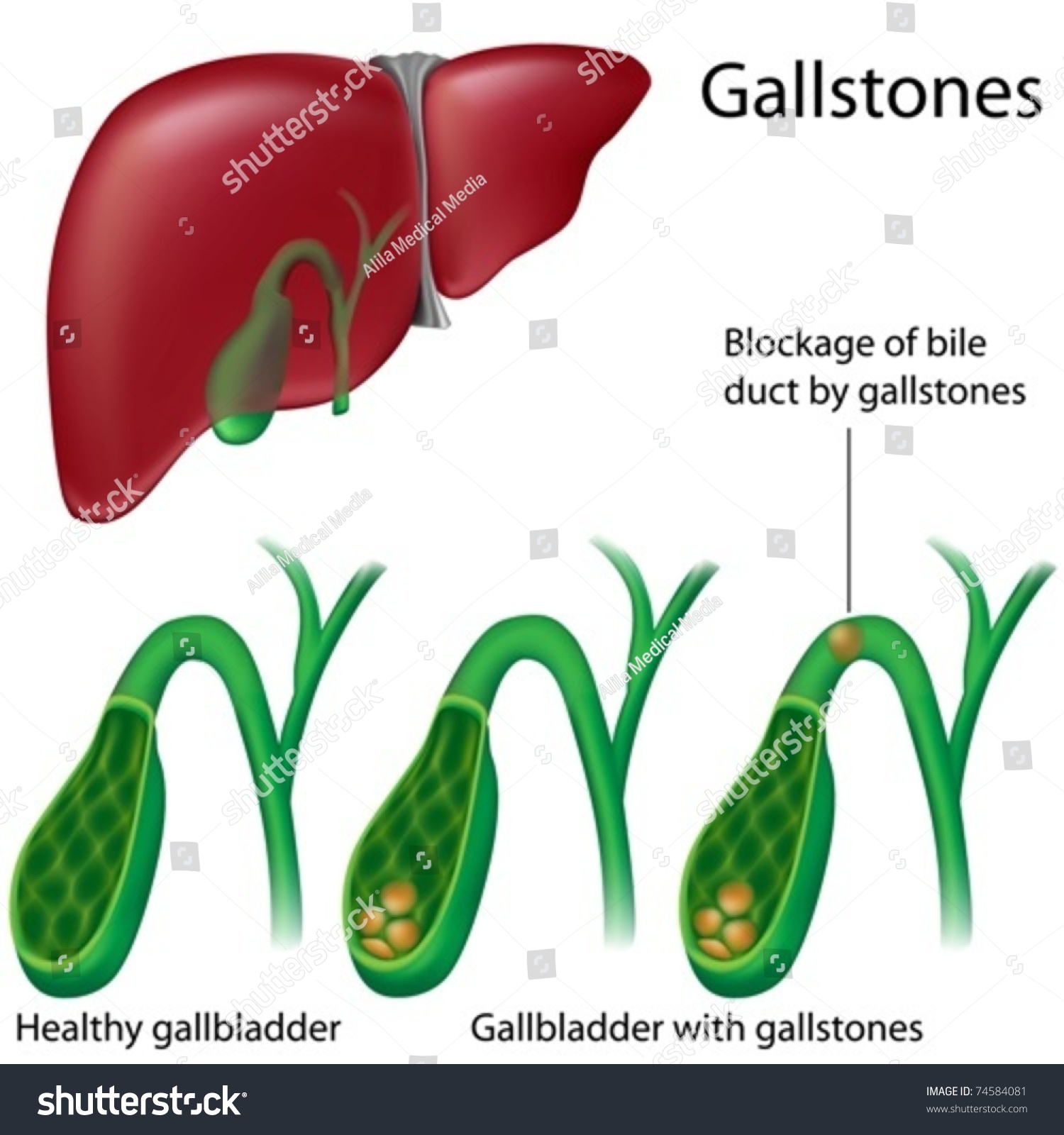 Cross Section Of Gallbladder With And Without Gallstones Stock Vector