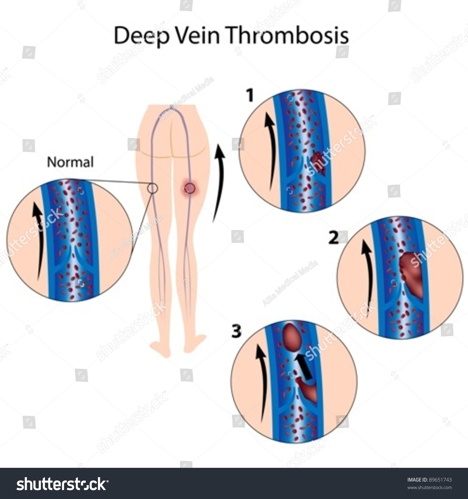 Deep Vein Thrombosis Pulmonary Embolism Stock Vector 89651743 Shutterstock