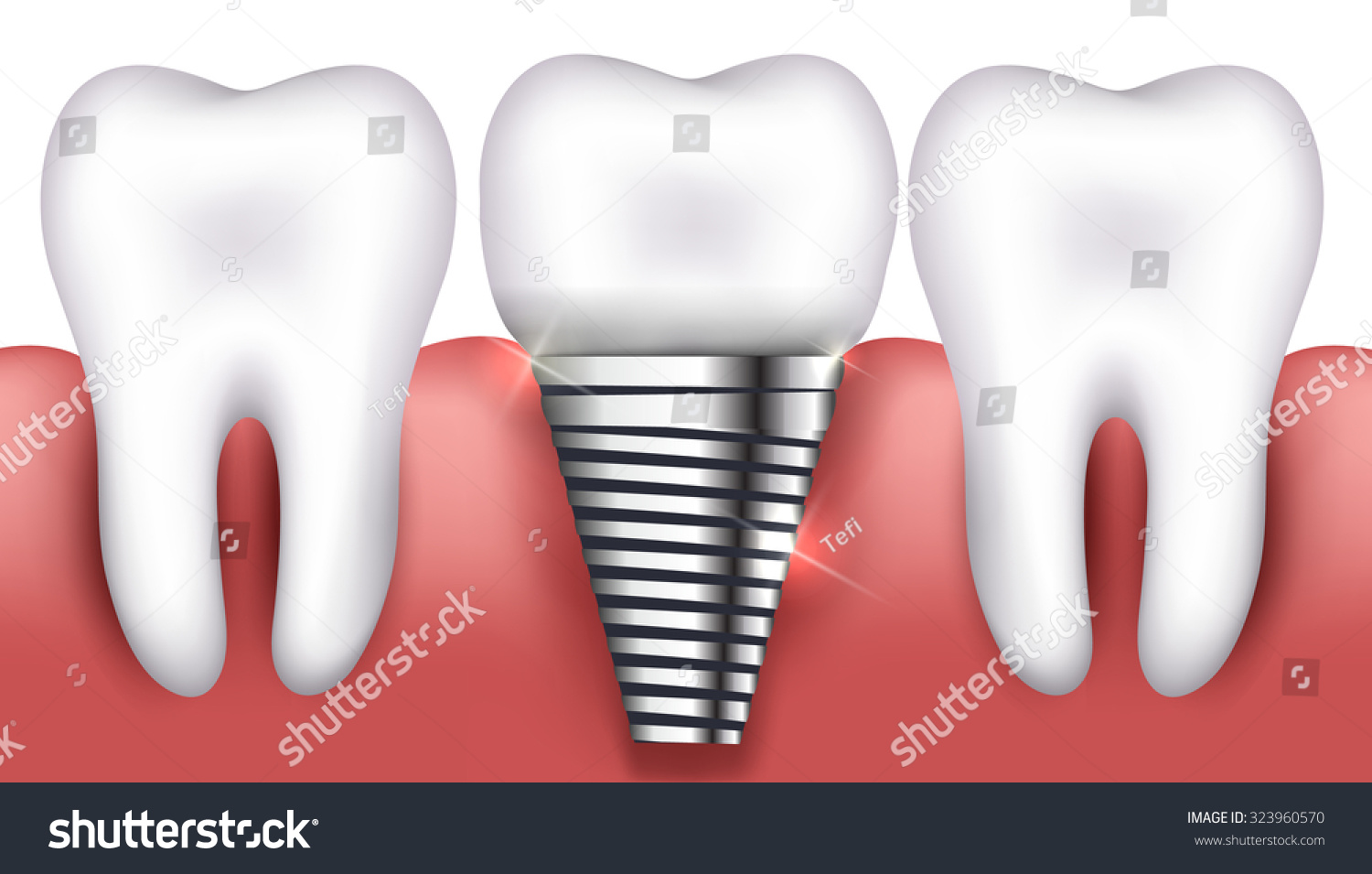 Dental implant and normal tooth beautiful bright illustration Dental implant and normal tooth beautiful bright illustration