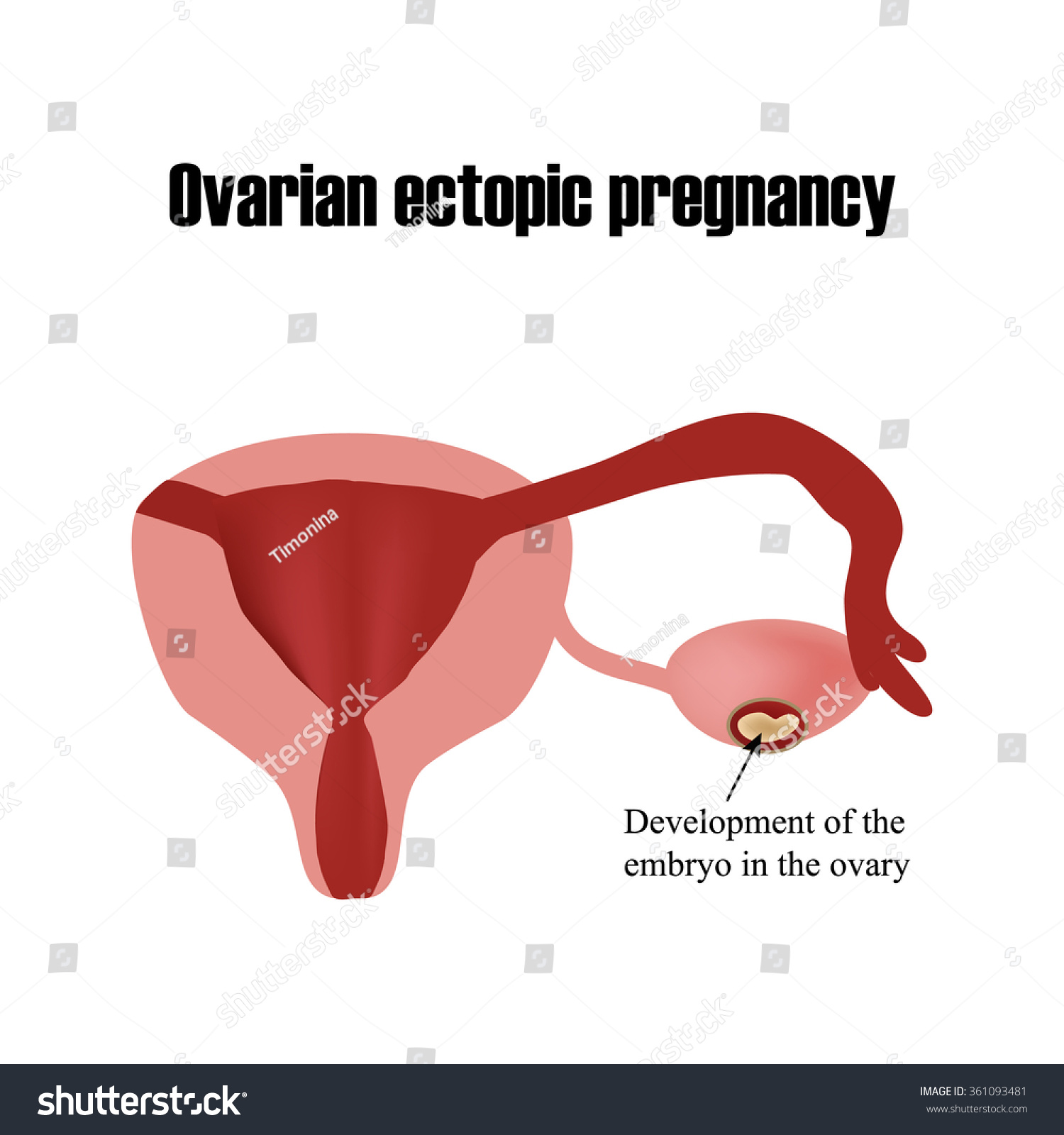 Development Embryo Ovary Ectopic Pregnancy Infographics Stock Vector Royalty Free