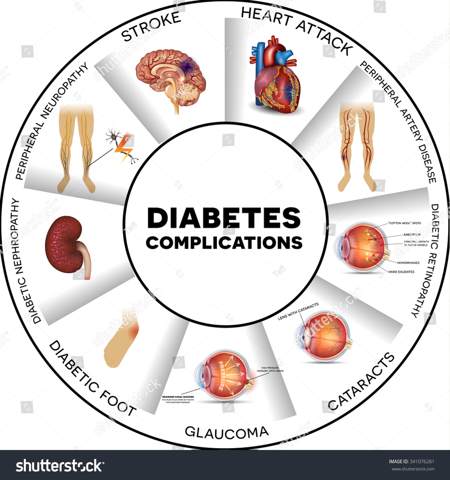 Diabetes Complications Affected Organs Round Info Graphic Stock Vector Illustration 341076281 2574