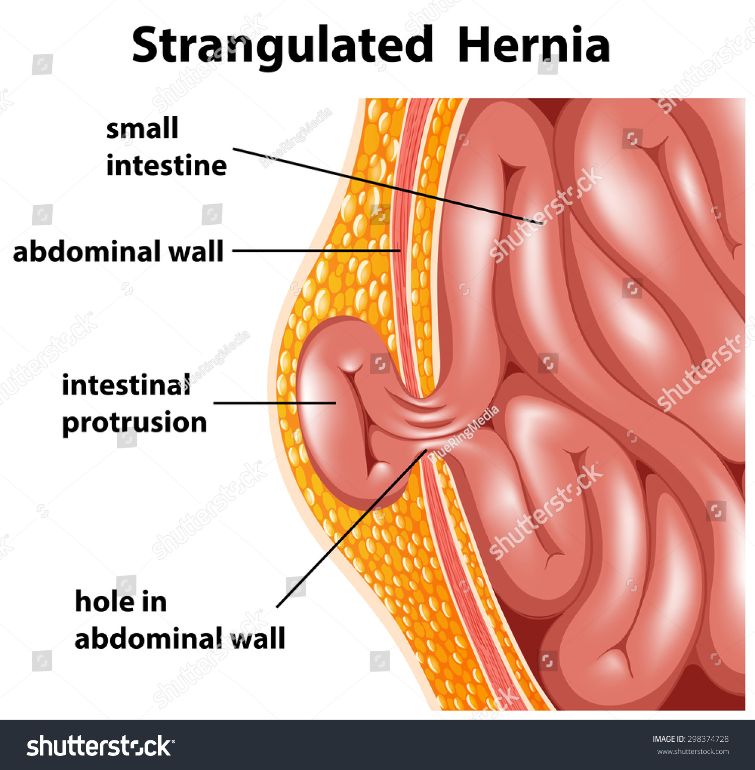 Diagram Inside Strangulated Hernia Stock Vector Shutterstock