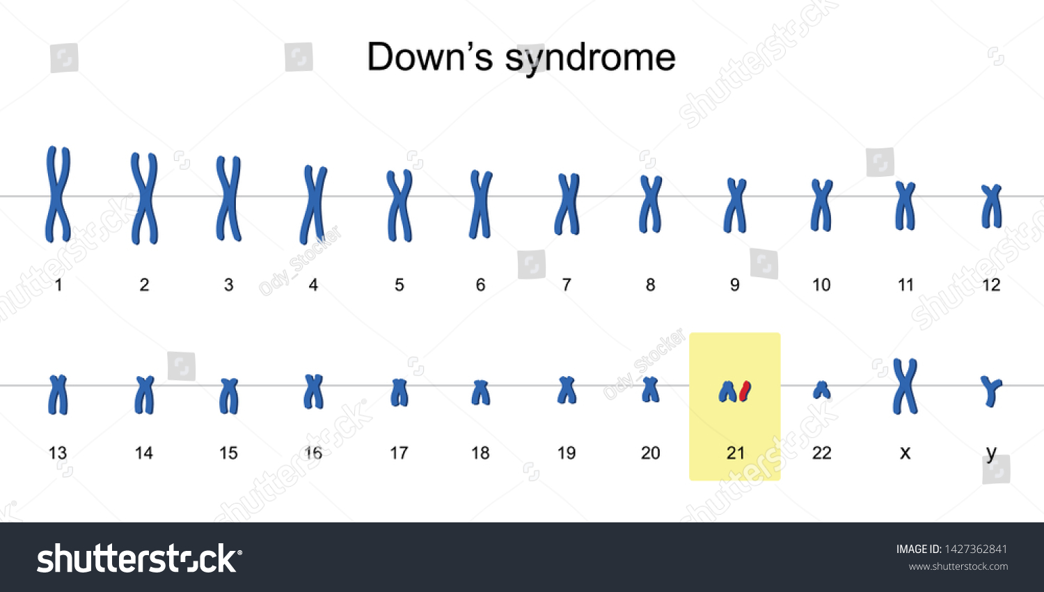 Vektor Stok Downs Syndrome Karyotype Autosomal Abnormalities Trisomy