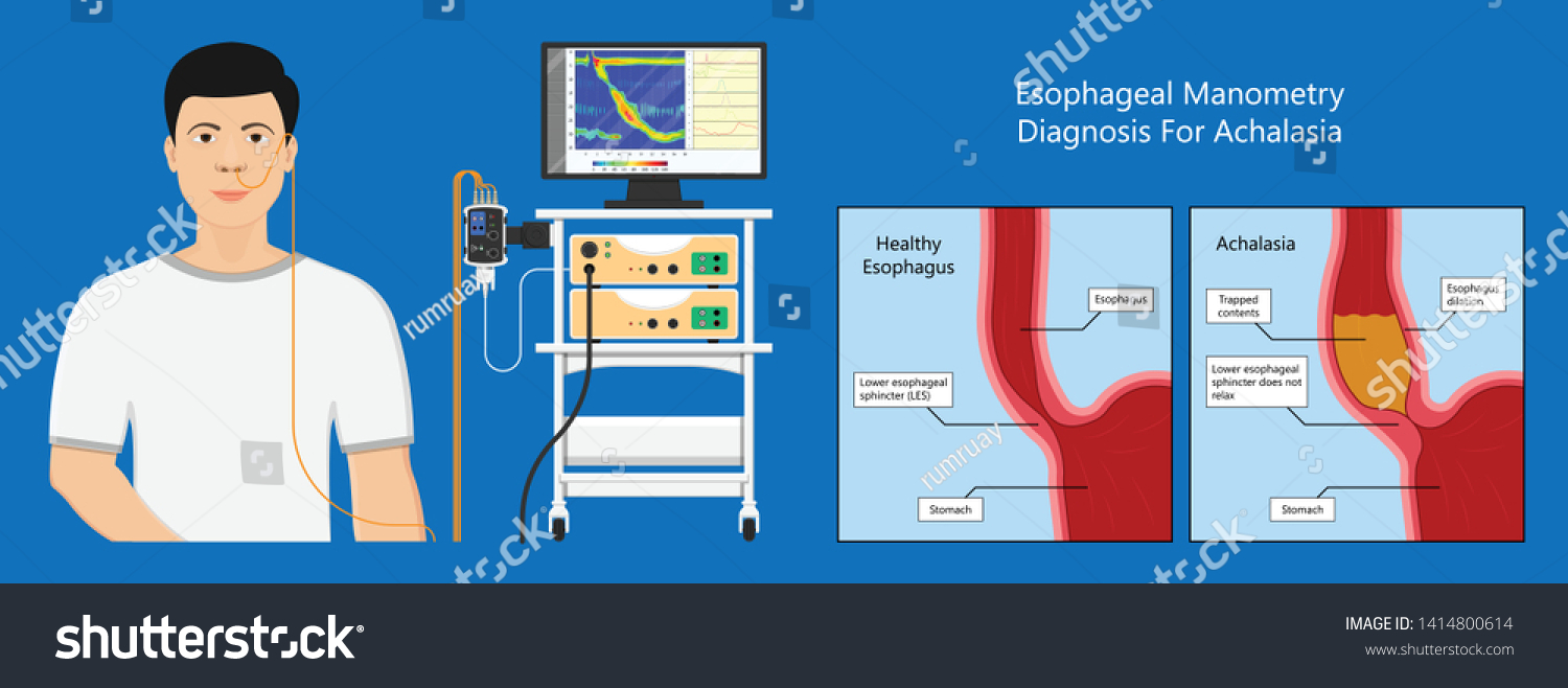 Esophageal Manometry Test Esophageal Diagnose Food 스톡 벡터 로열티 프리