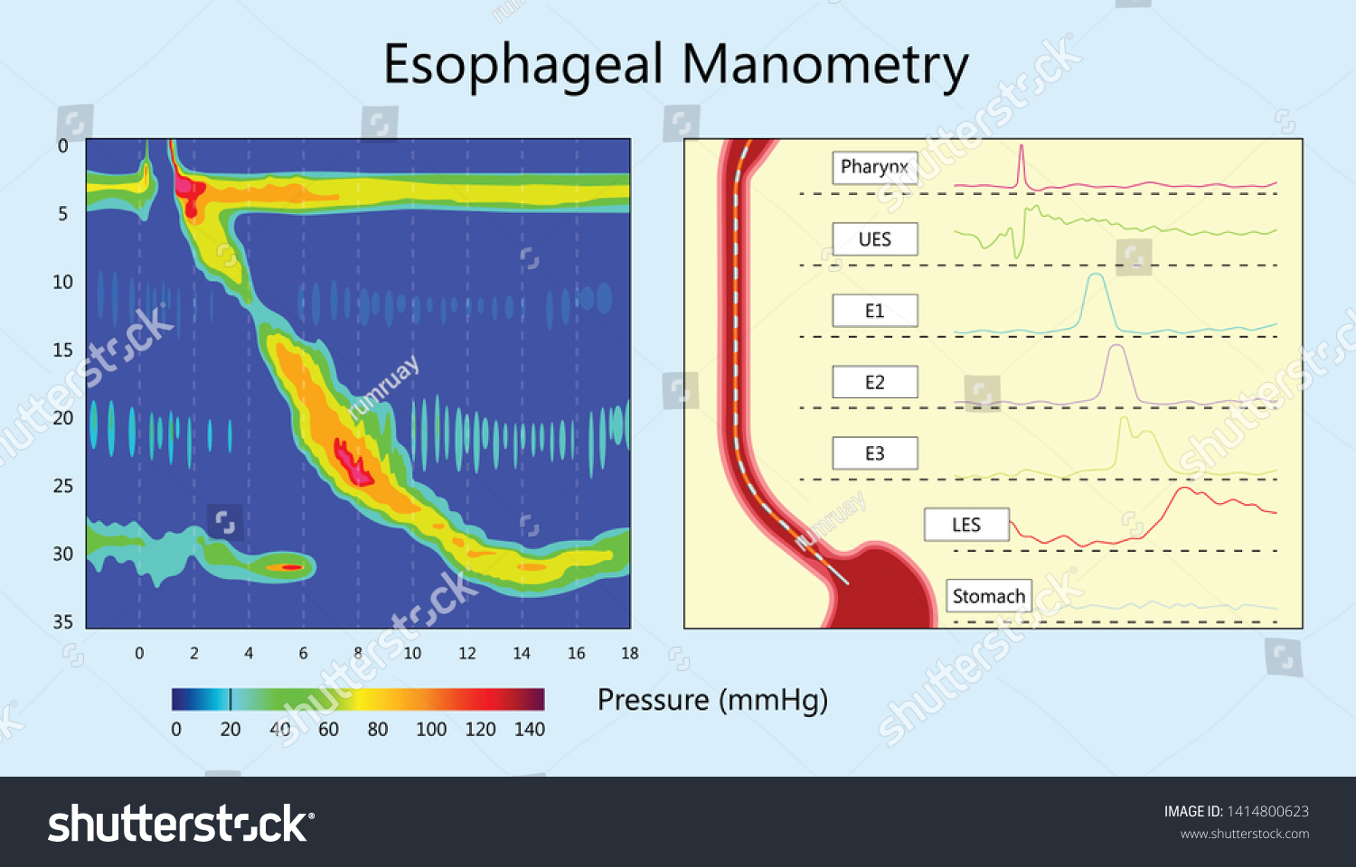 Esophageal Manometry Test Esophageal Diagnose Food Stock Vector