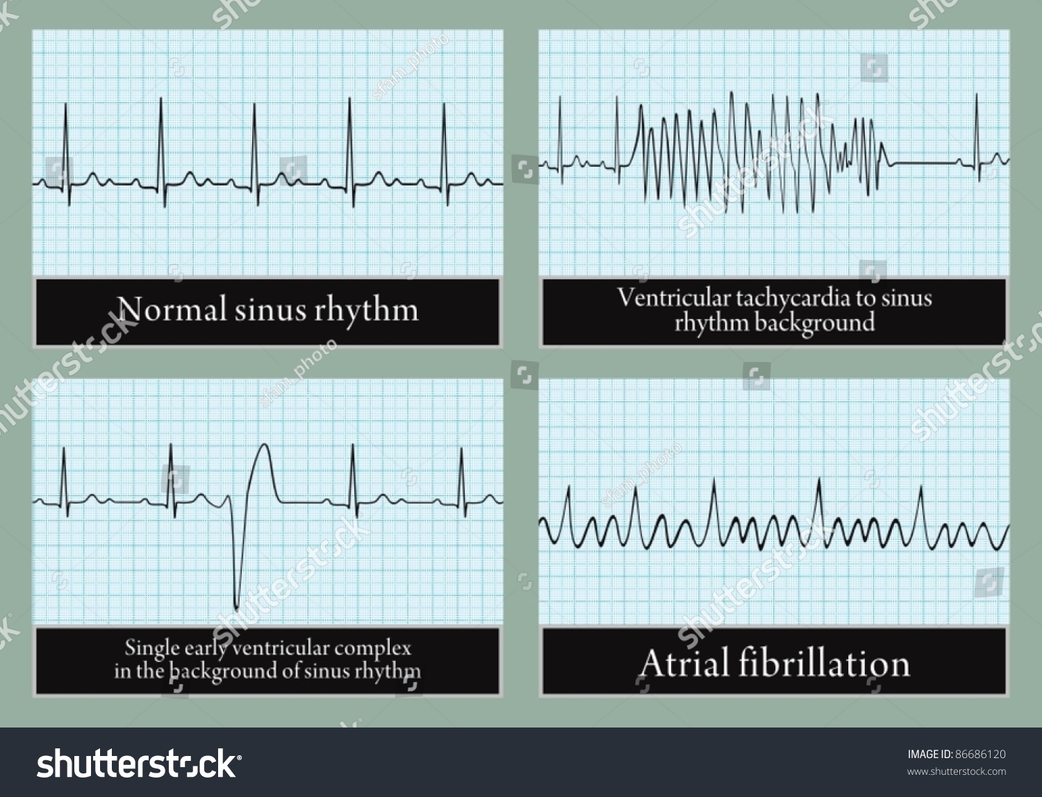 examples-of-normal-and-abnormal-ecg-vector-professional-information