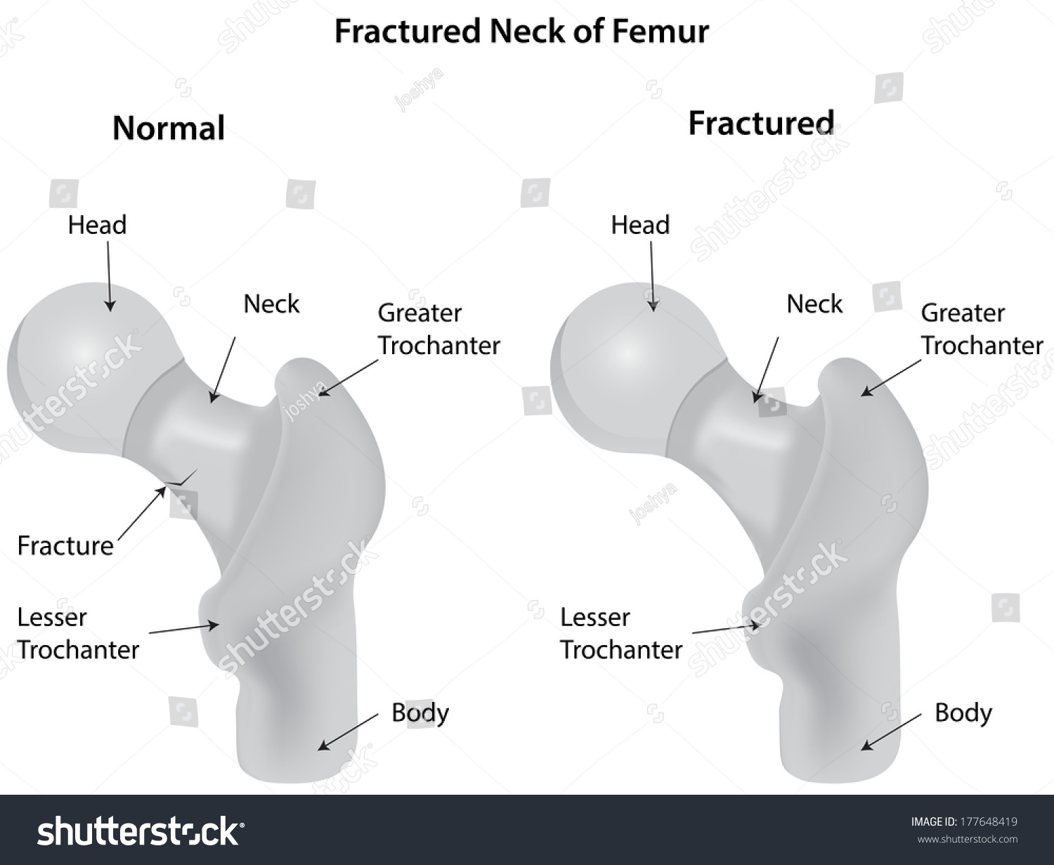 fractured neck of femur guidelines