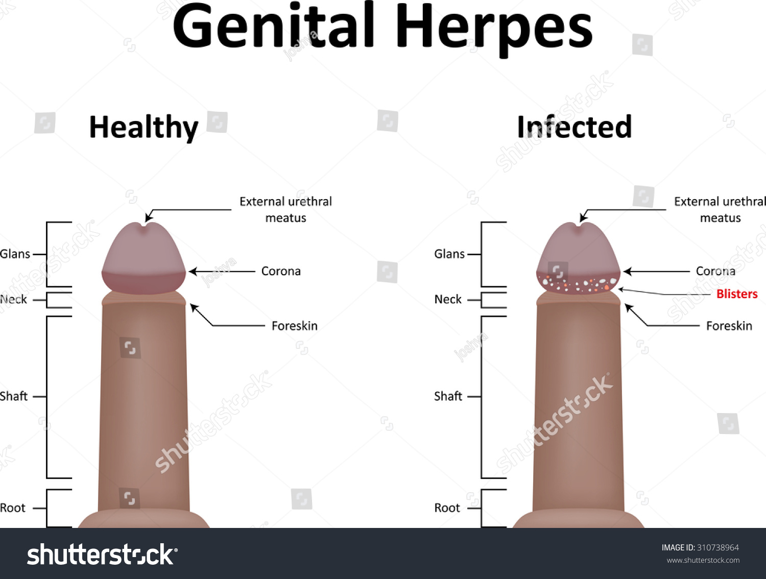 Head of penis wrinkled - Herpes - MedHelp