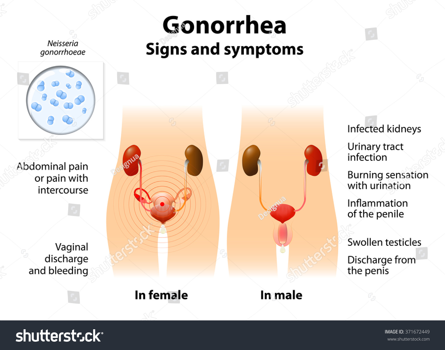 Gonorrhea Or Gonococcal Urethritis. Sexually Transmitted Infection That Is Caused By ...1500 x 1182