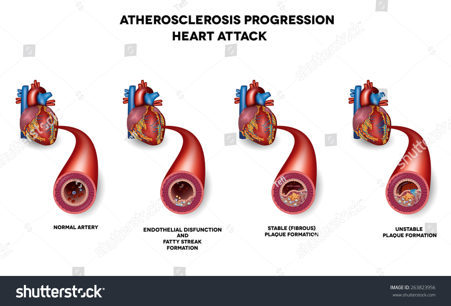 Heart Attack, Coronary Artery Disease. Heart Muscle Damage Due To Blood 