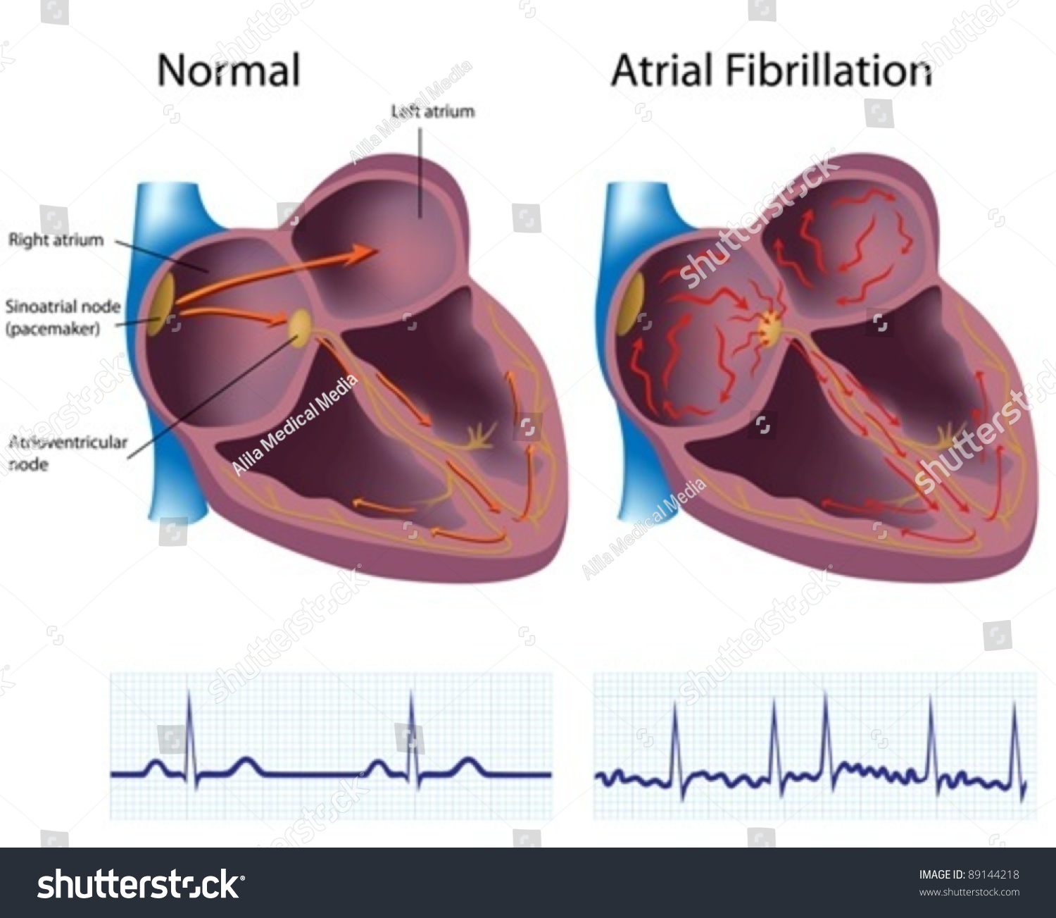 Heart Disease - Atrial Fibrillation Stock Vector Illustration 89144218 ...