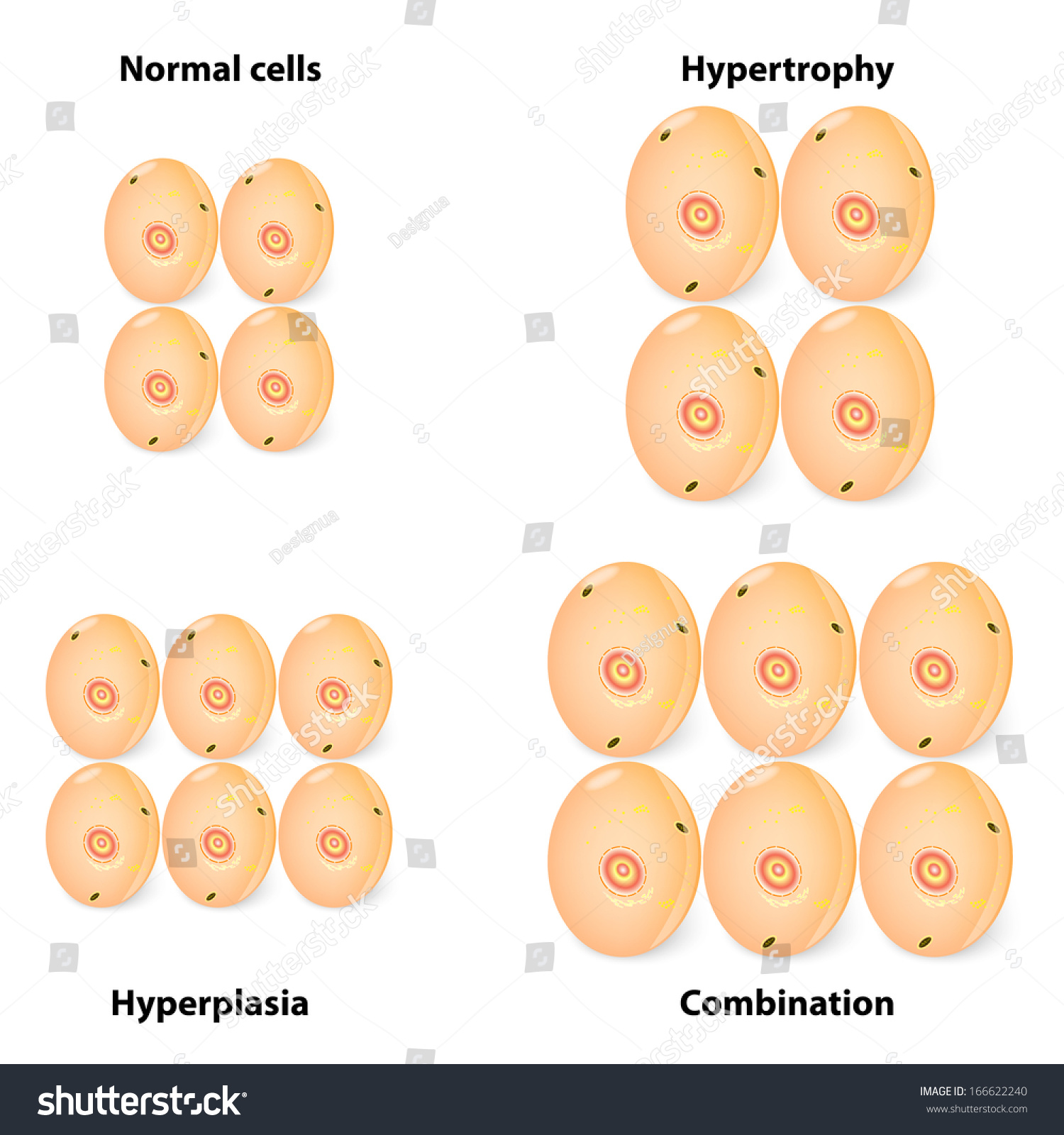 hyperplasia-hypertrophy-and-normal-cells-illustration-showing-the