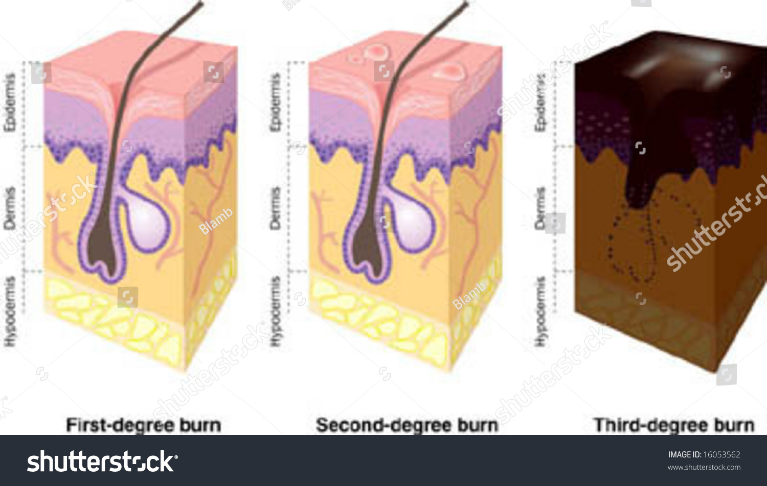 Illustration Of First Second And Third Degree Burns 16053562 Shutterstock 1721