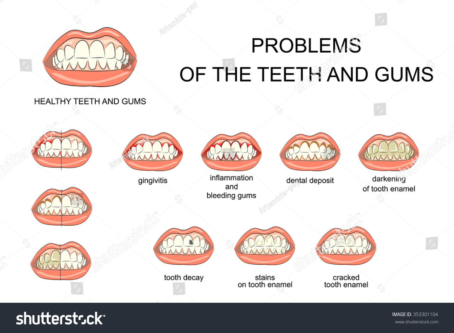 Illustration Of Healthy Gums And Teeth And Oral Cavity Diseases ...