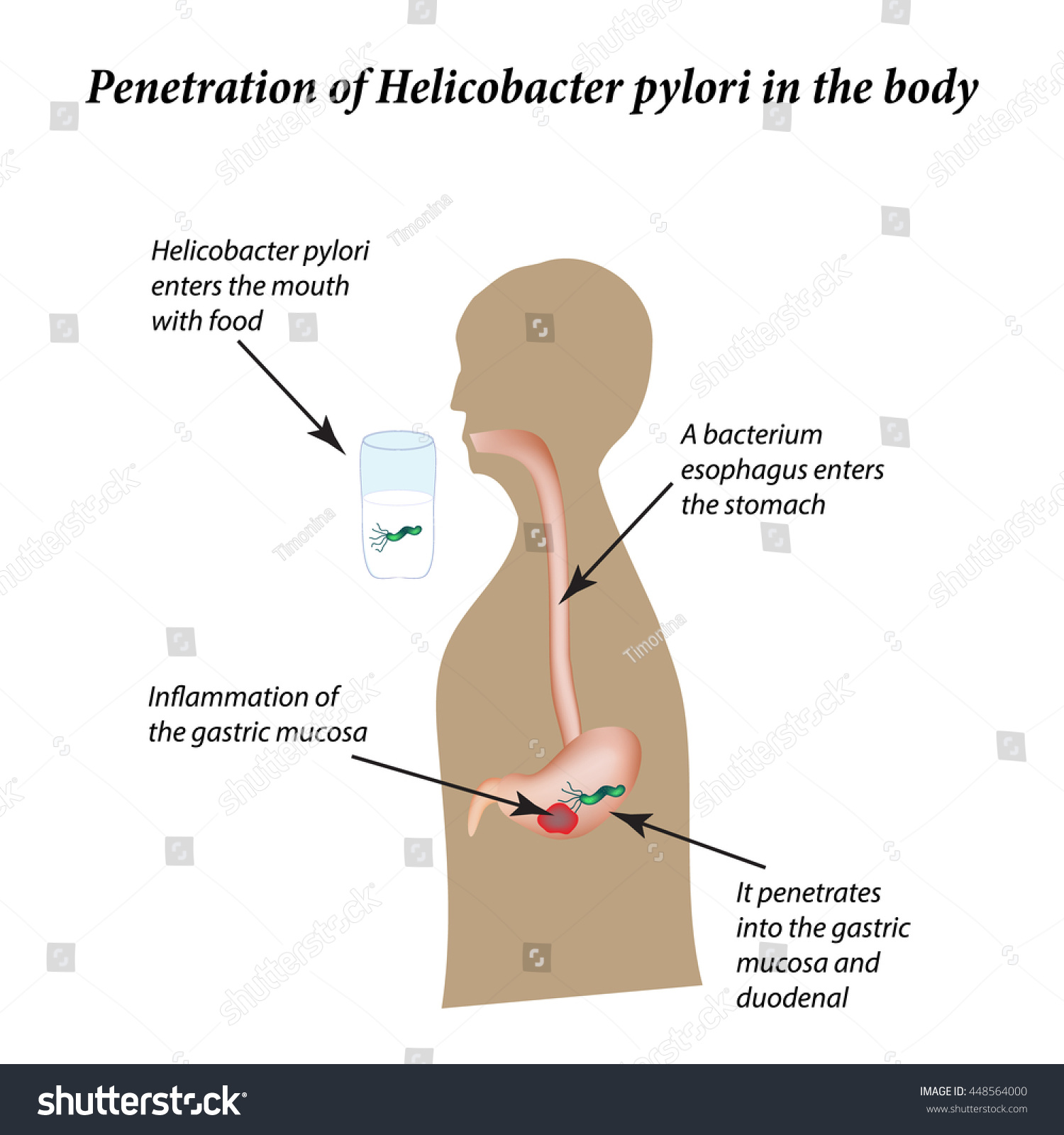 Infection Helicobacter Pylori Infographics Vector Illustration 库存矢量图免