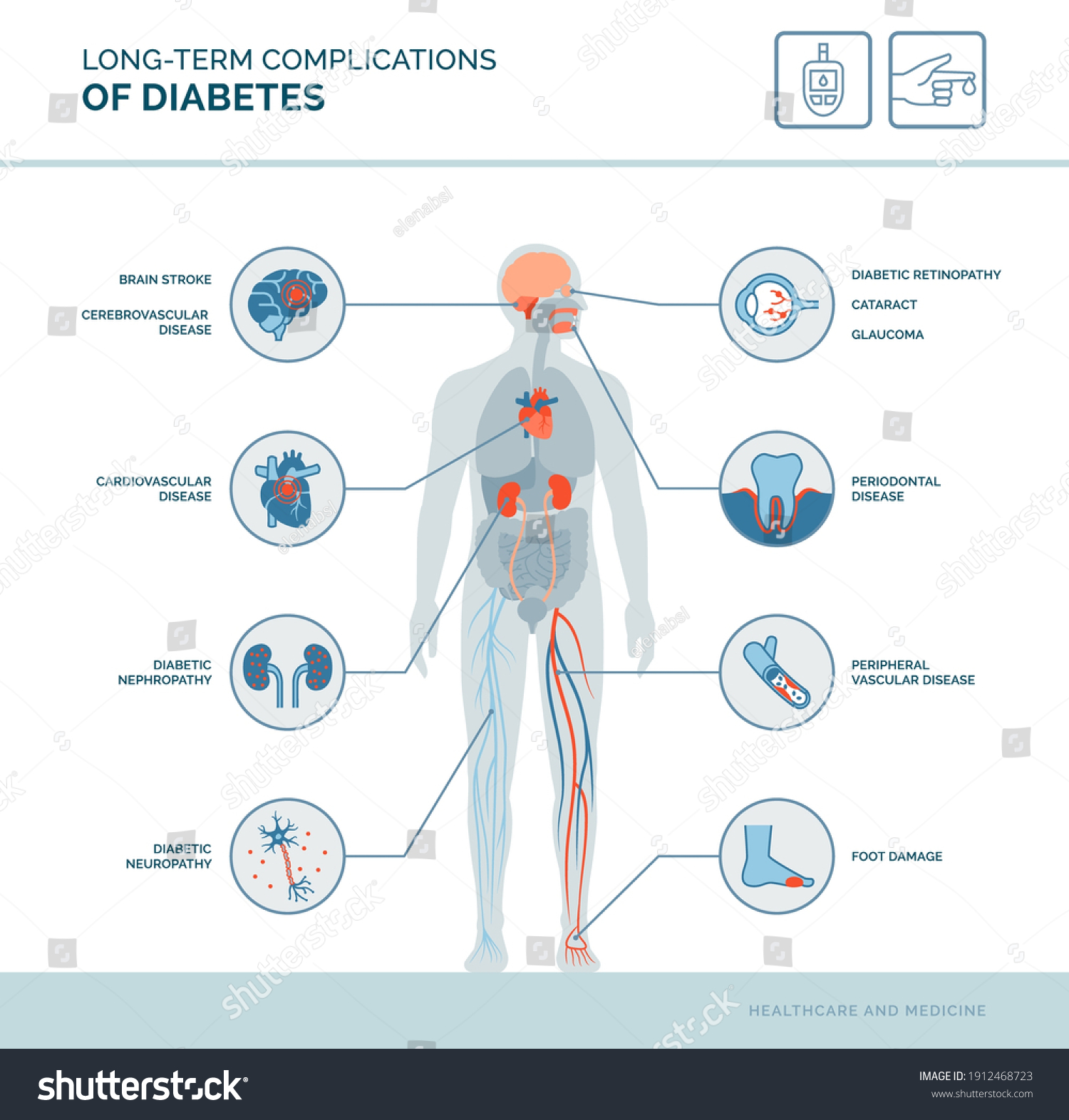 Longterm Complications Diabetes Medical Infographic Diabetes Stock