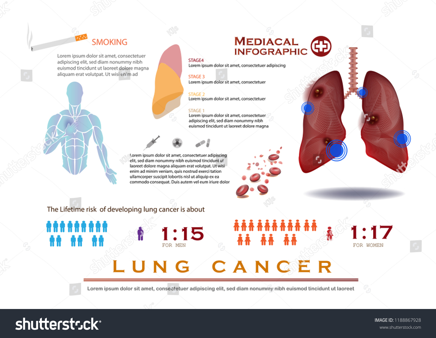 Lung Cancer Infographic Stock Vector Royalty Free 1188867928