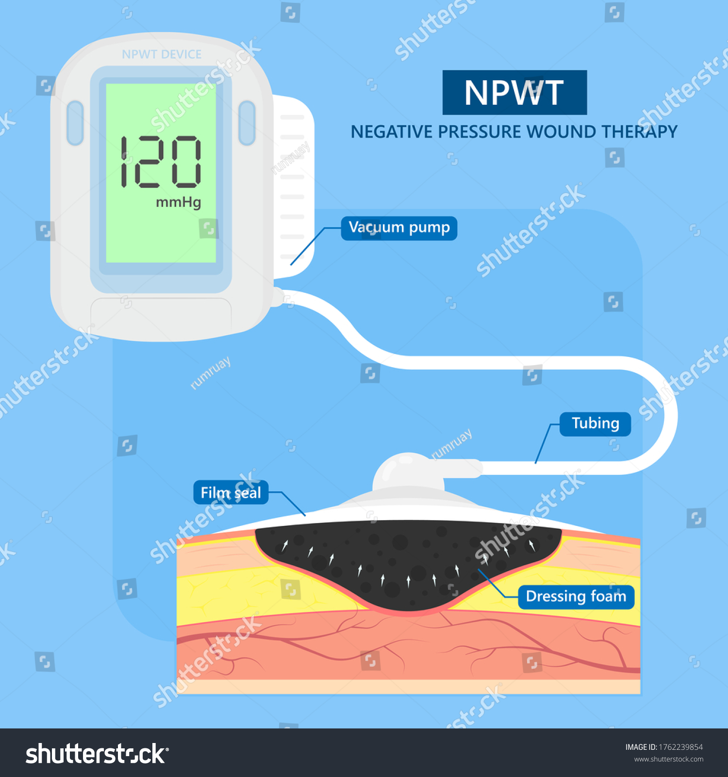 Negative Pressure Wound Therapy Images Stock Photos Vectors