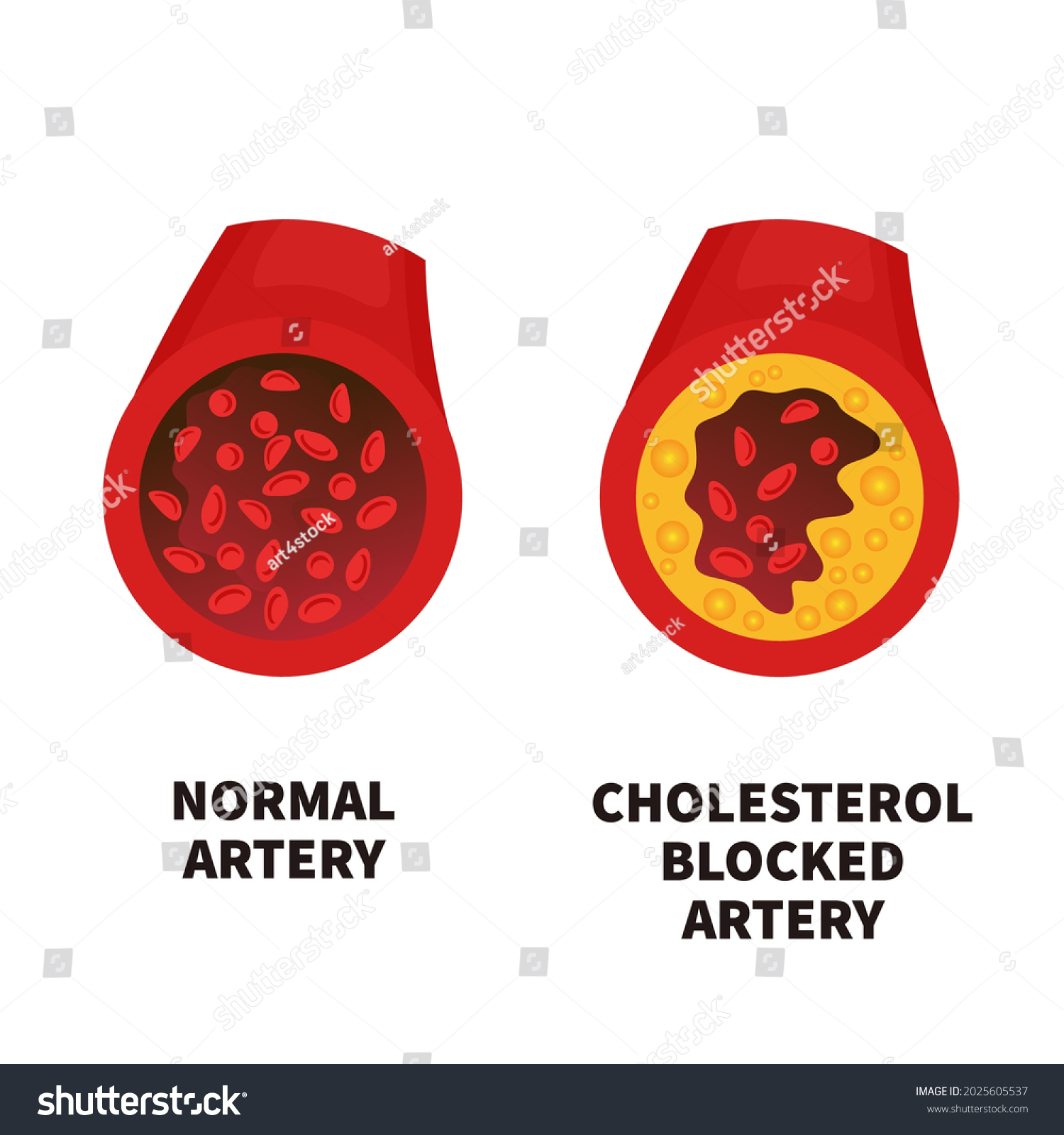 Normale Blutgef E Gegen Arterie Mit Cholesterin Plaque Aufbau Stock